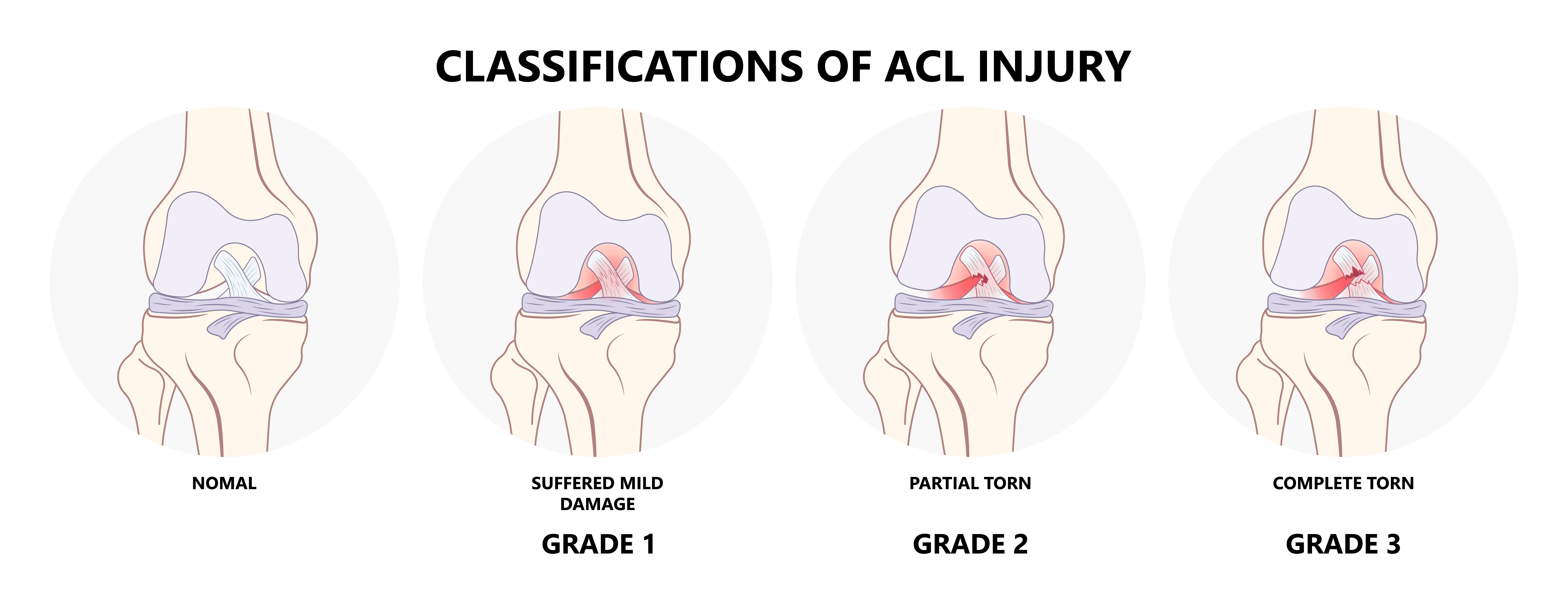 Klasifikacija poškodbe sprednje križne vezi