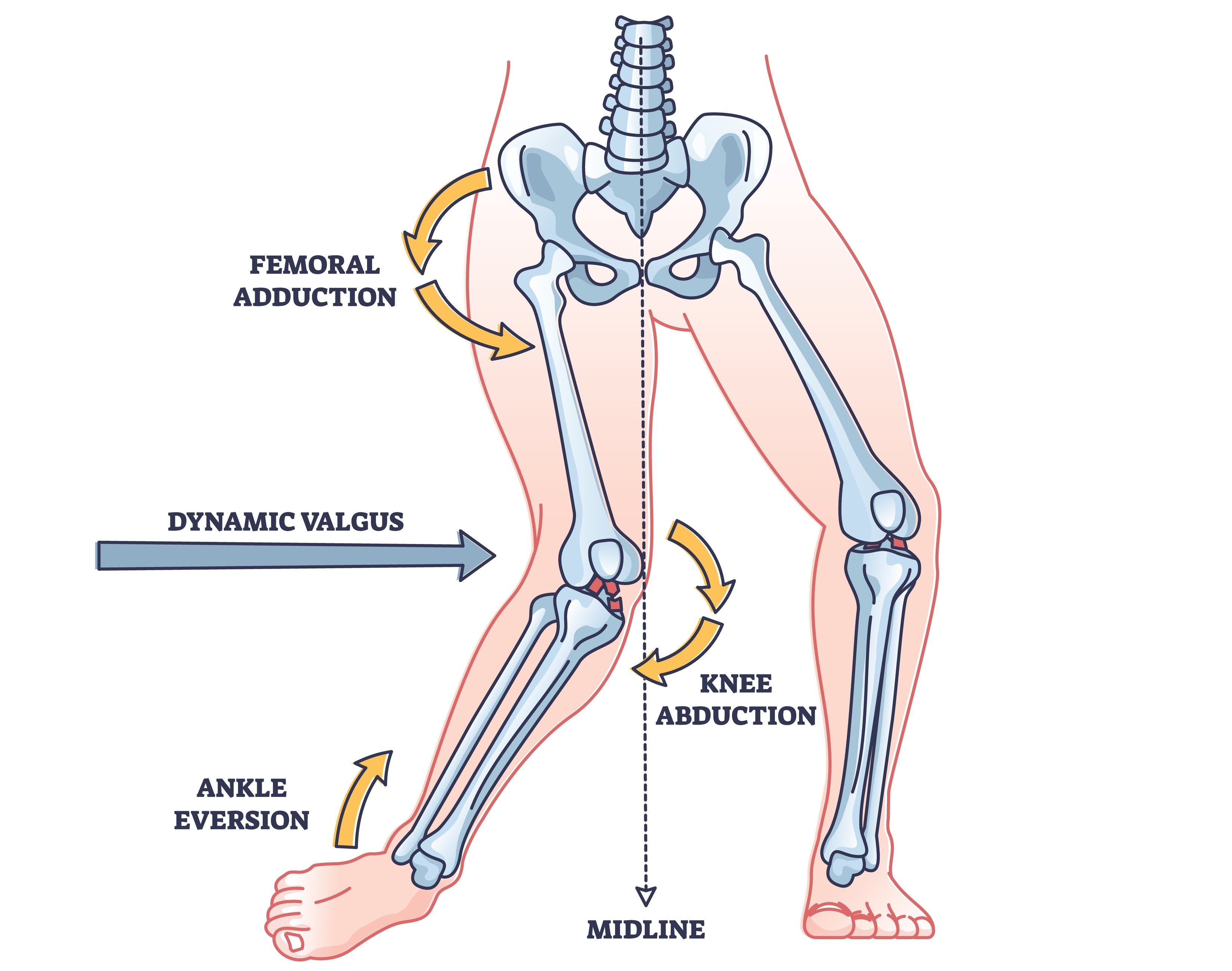 Mehanizem poškodbe ACL