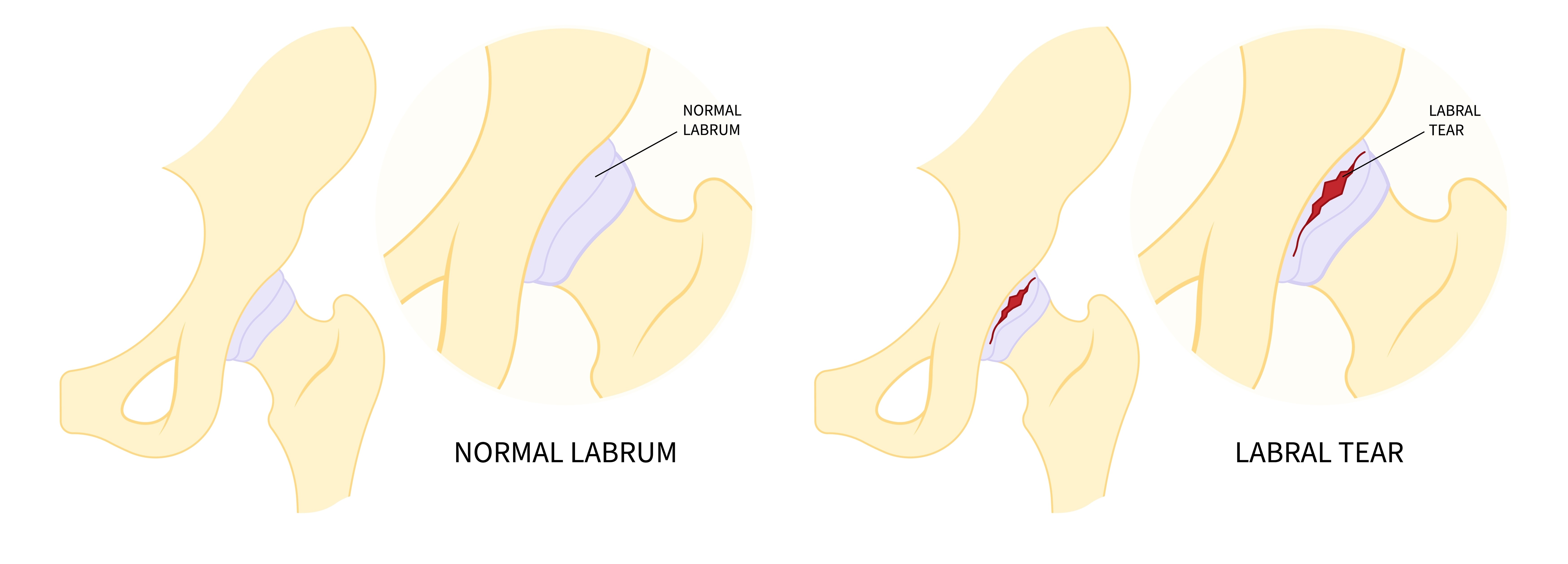 Poškodba labruma kolka