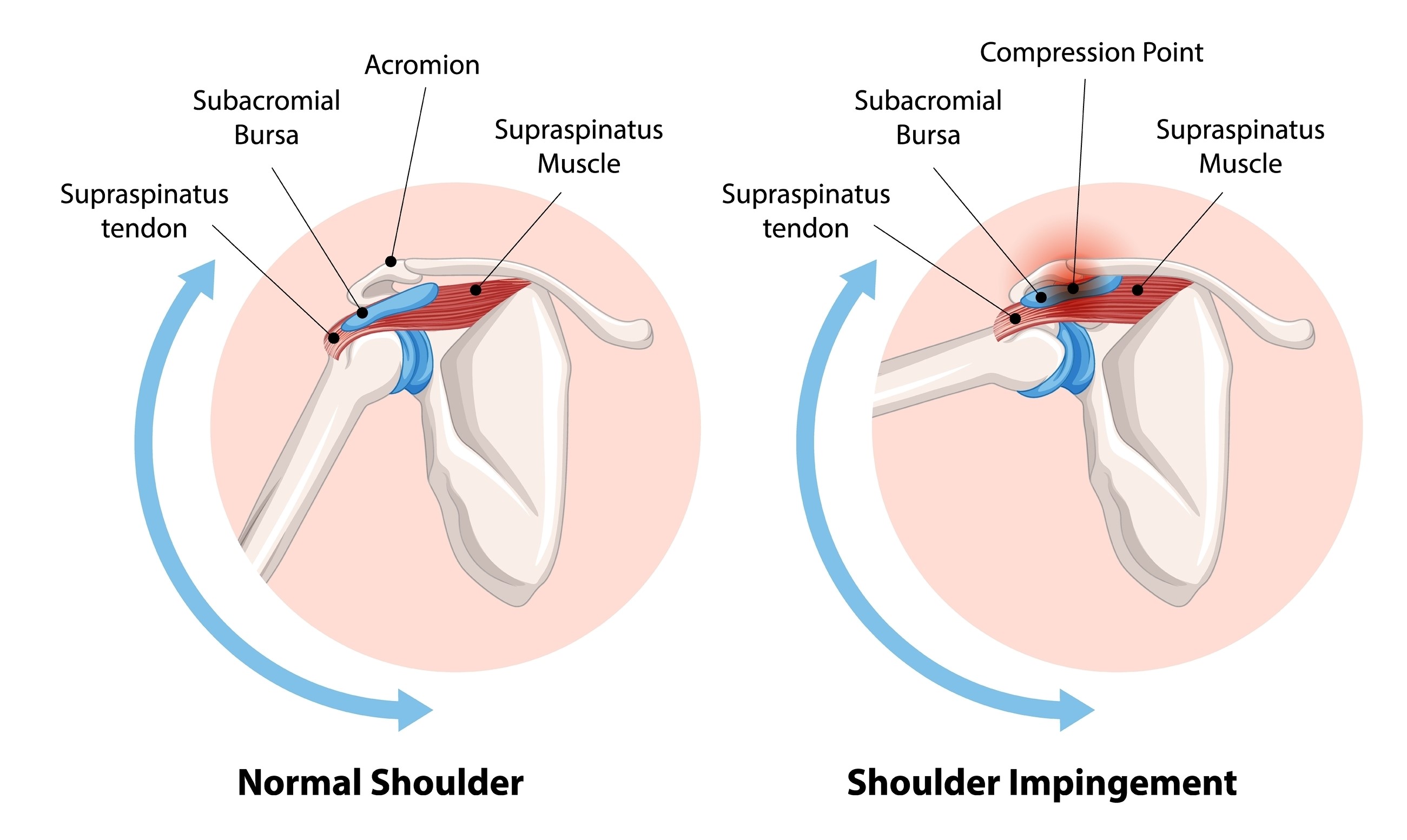 Zagozditveni sindrom ramena