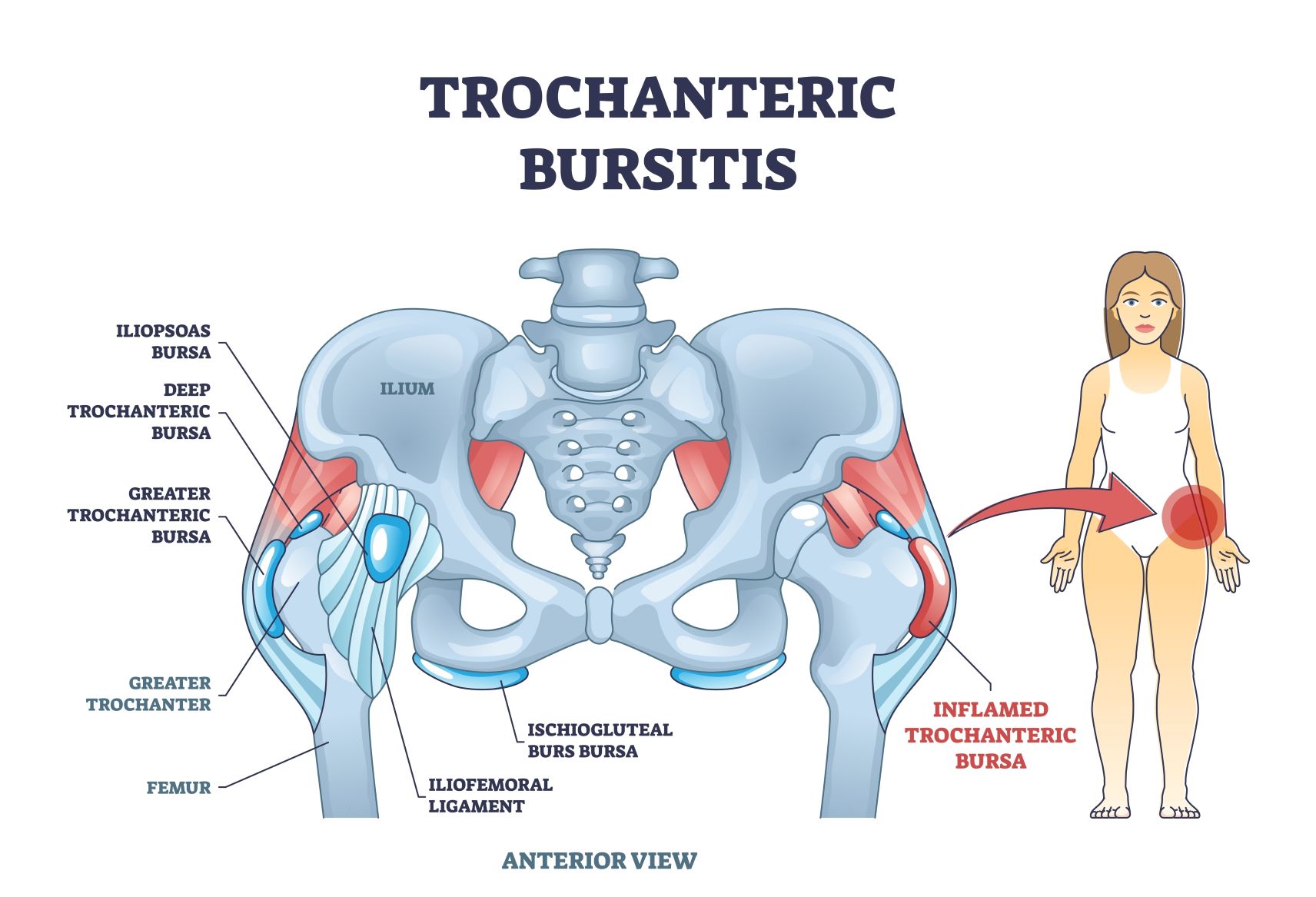 Trohanterni Burzitis