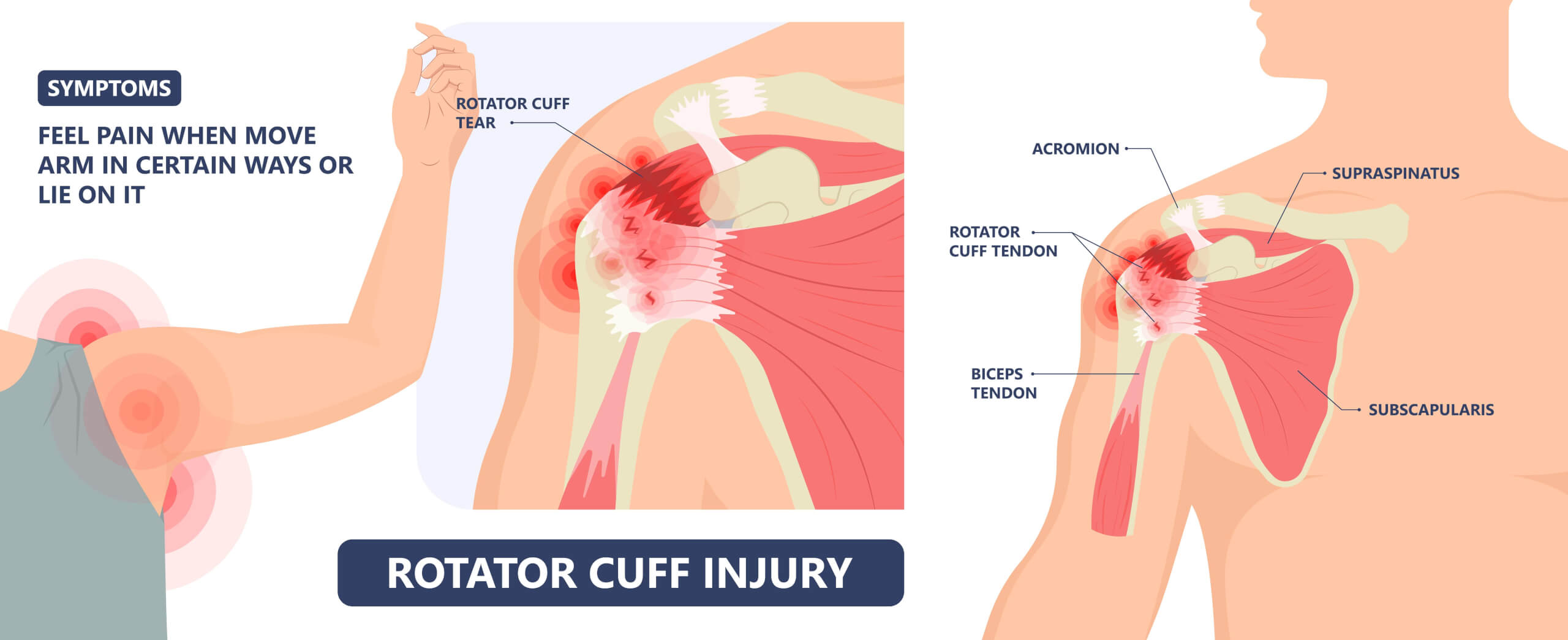 rotator cuff injury