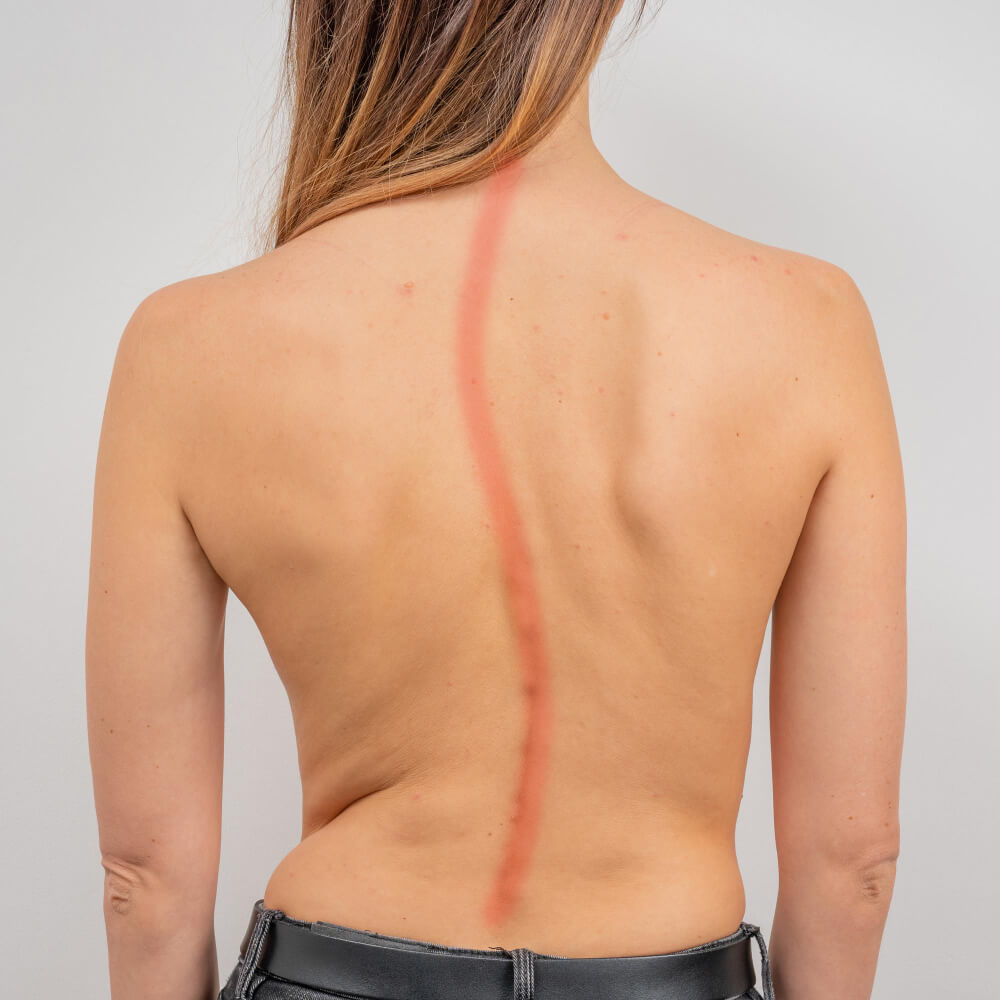 izris skolioze hrbtenice