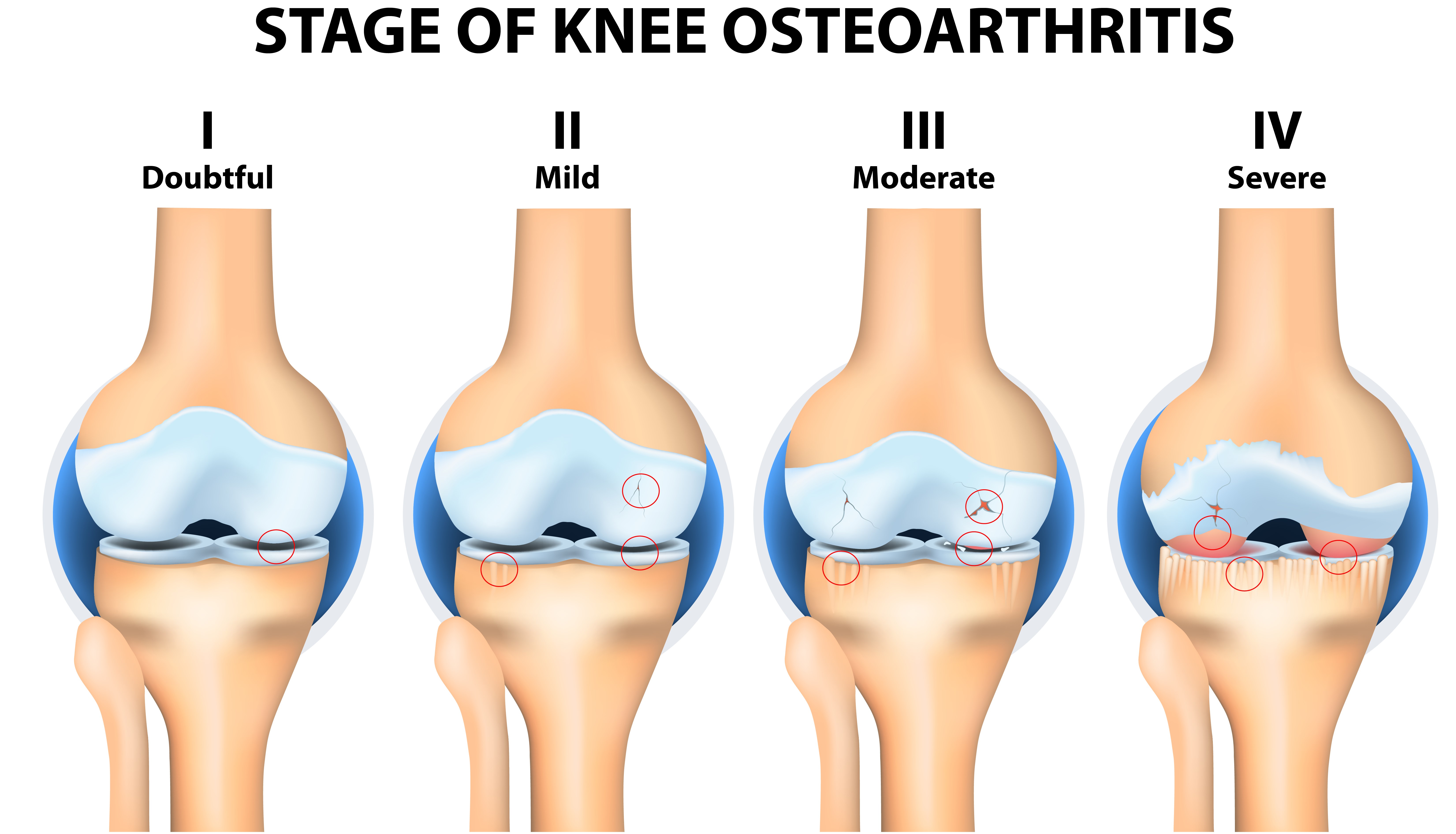 Stopnje osteoartroze