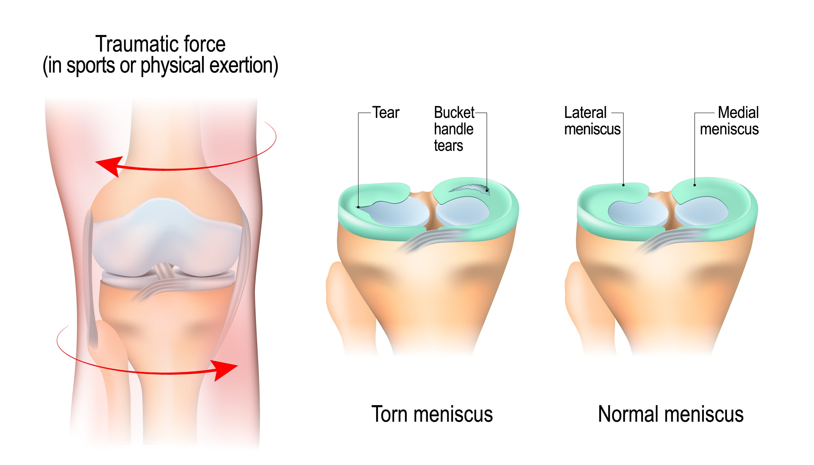 Mehanizem poškodbe meniskusa