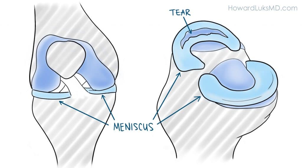 Meniscus injury – is physiotherapy really necessary?