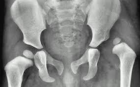 hip issues under xray