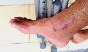 post-op ankle healing process