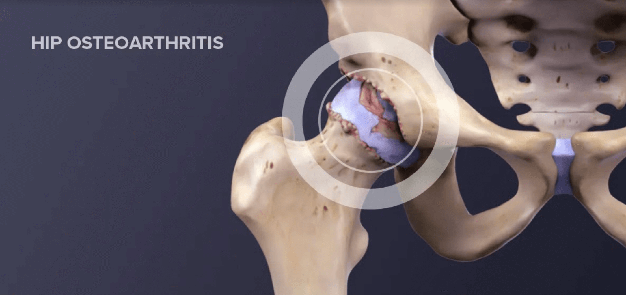 hip osteoarthritis