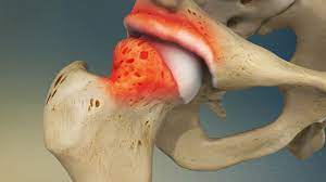 utesnitveni sindrom kolka