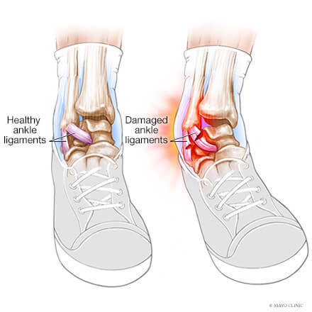 damaged ankle ligaments drawing