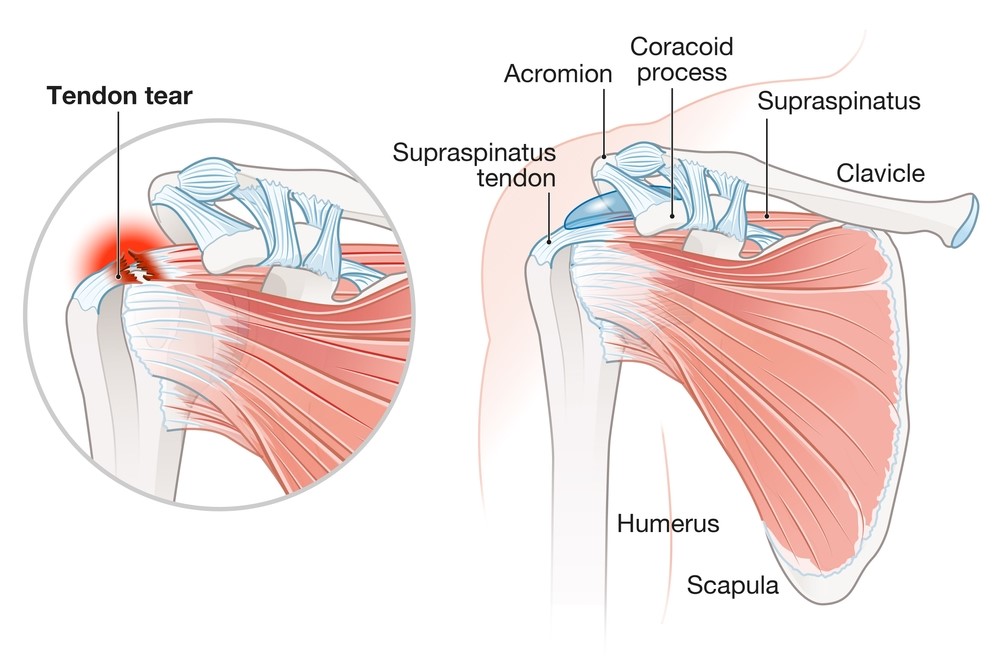 Ruptura tetive supraspinatusa