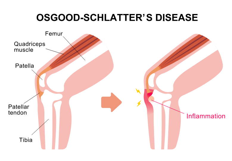 osgood schlater simptomi