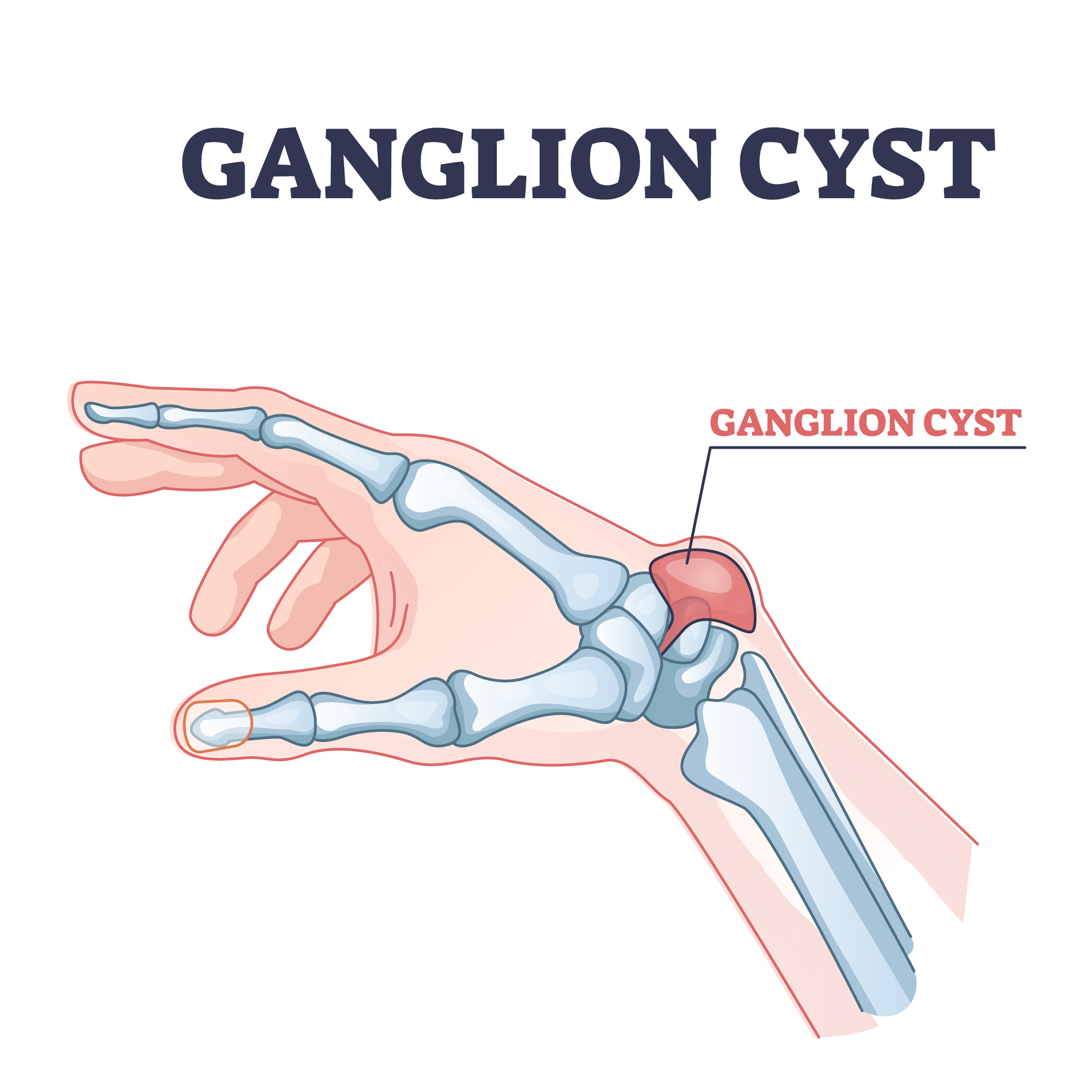 ganglion cista v zapestju