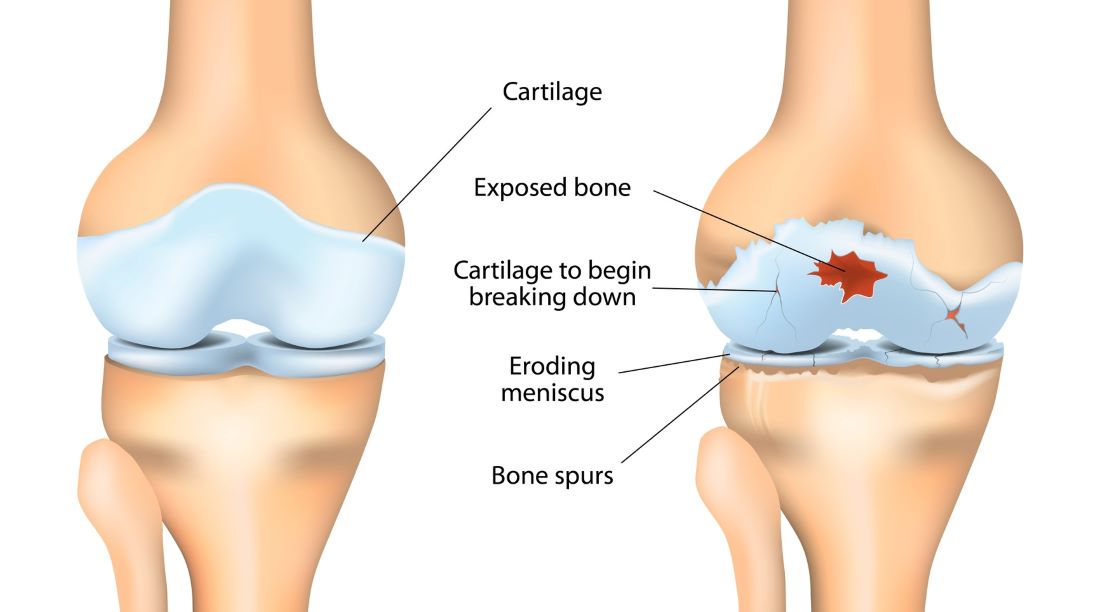 osteoartroza bolečine v sklepih