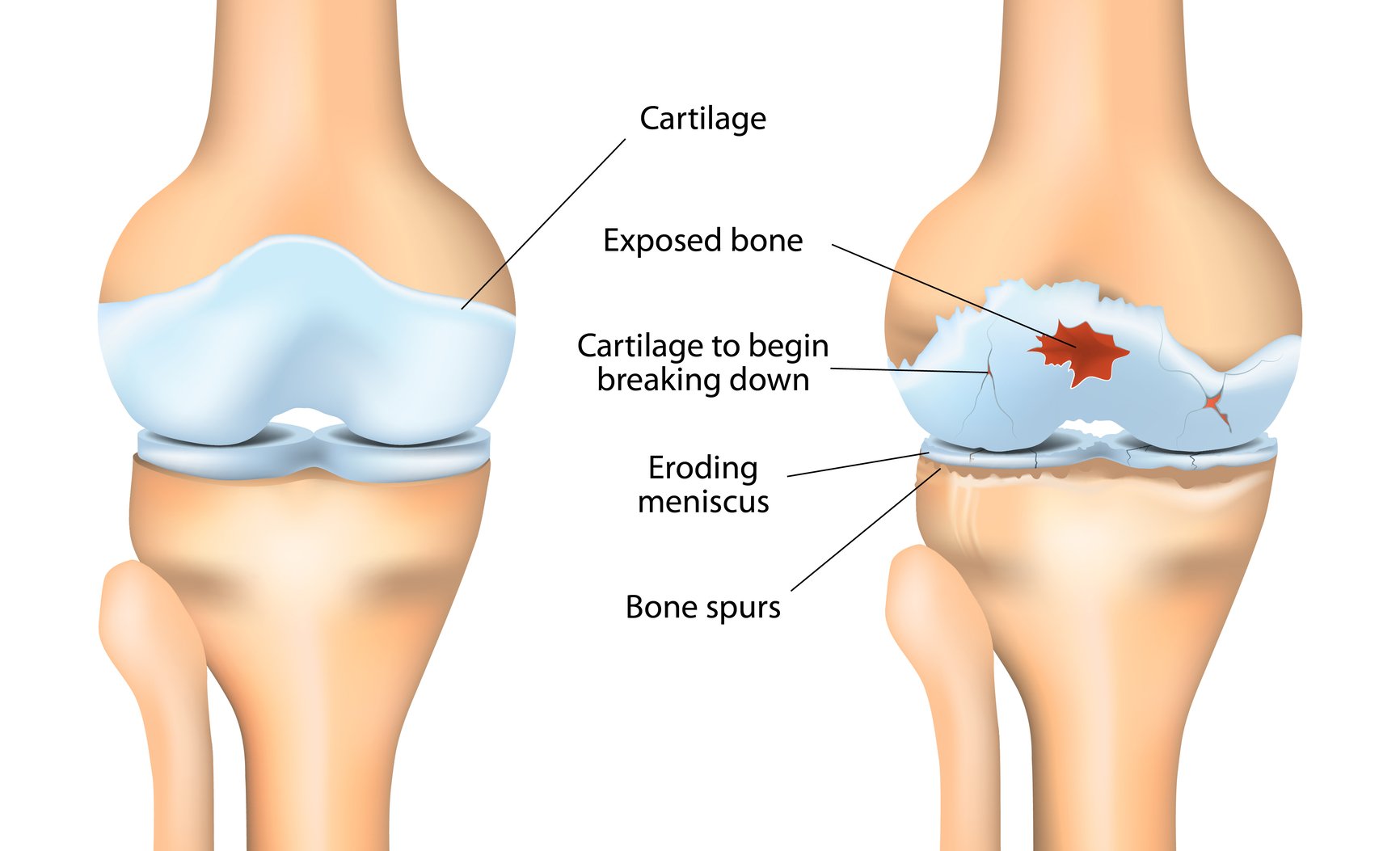 Kako nastane osteoartroza