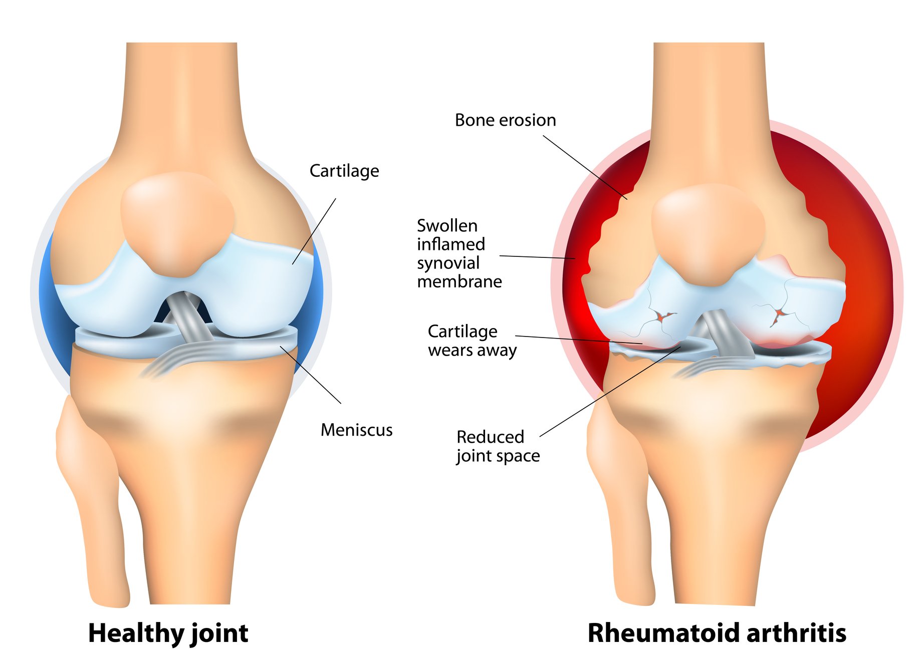 sklep pri revmatoidnemu artritisu
