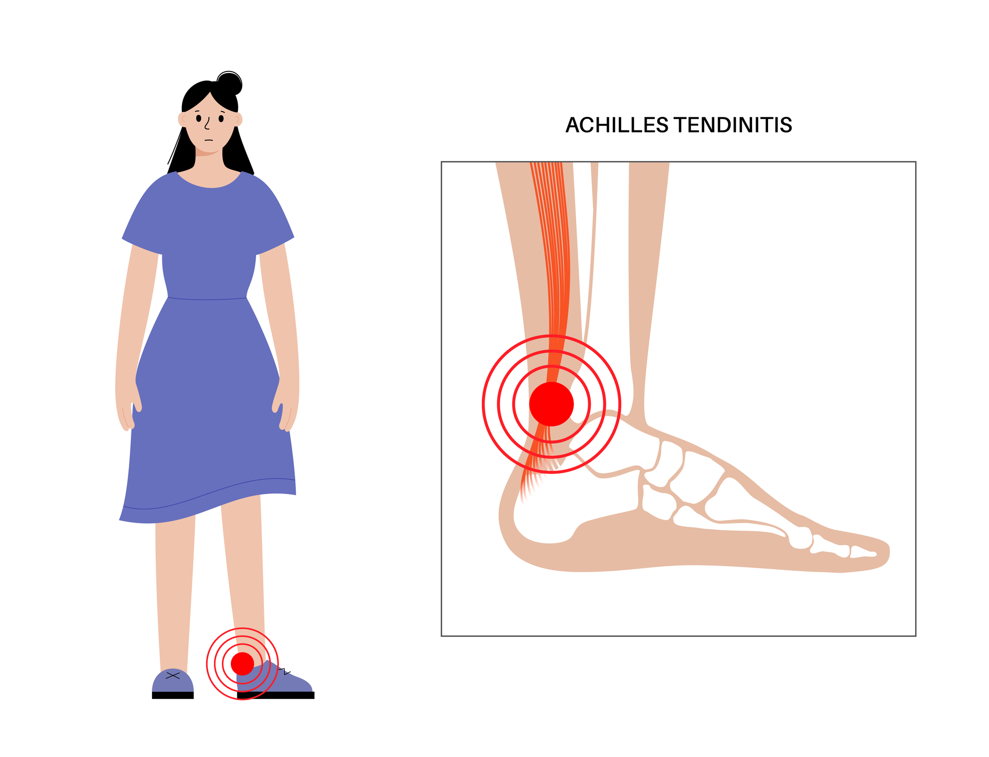 Tendinitis ahilove tetive bolečine