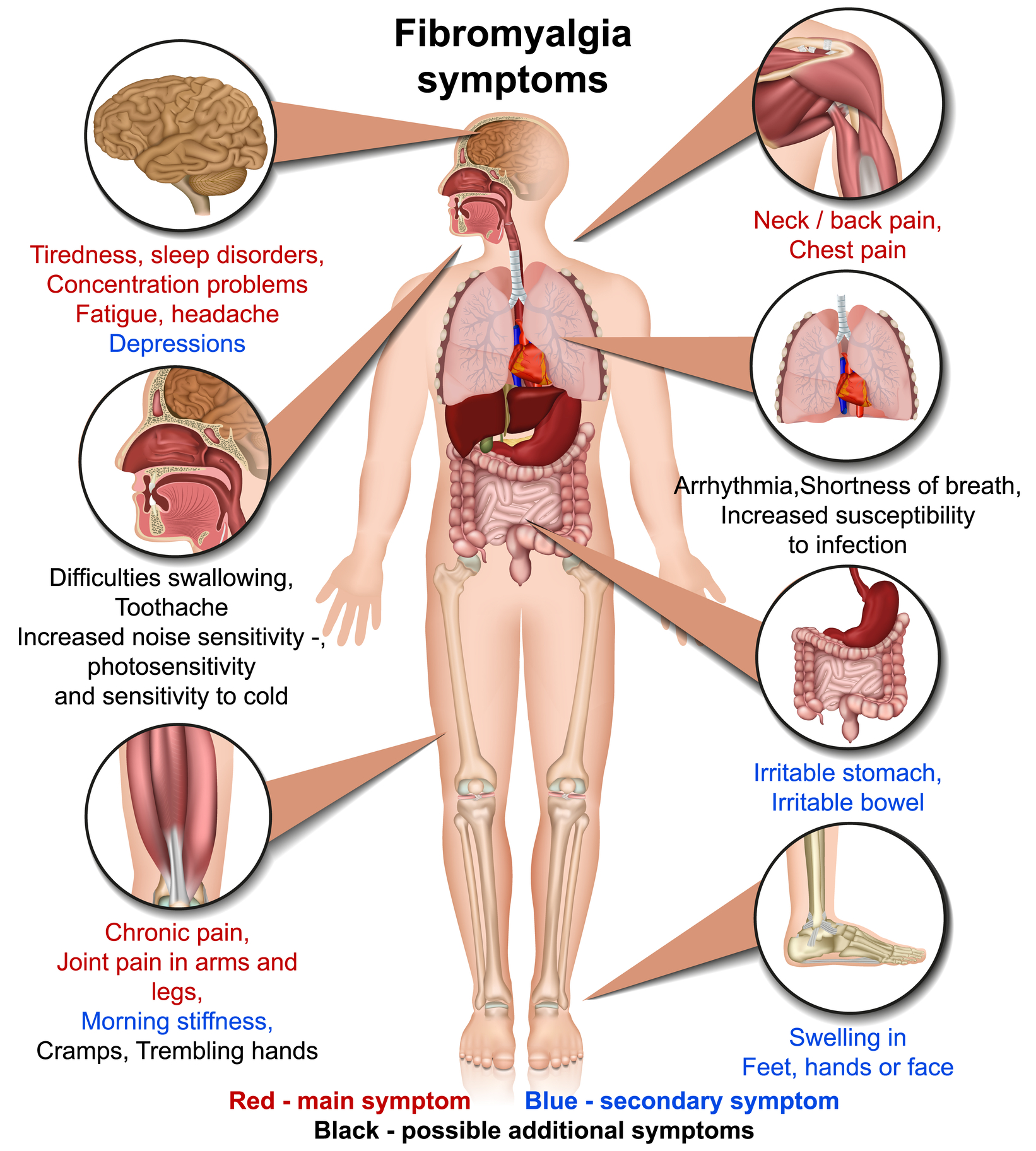 Fibromialgija utrujenost in bolečine