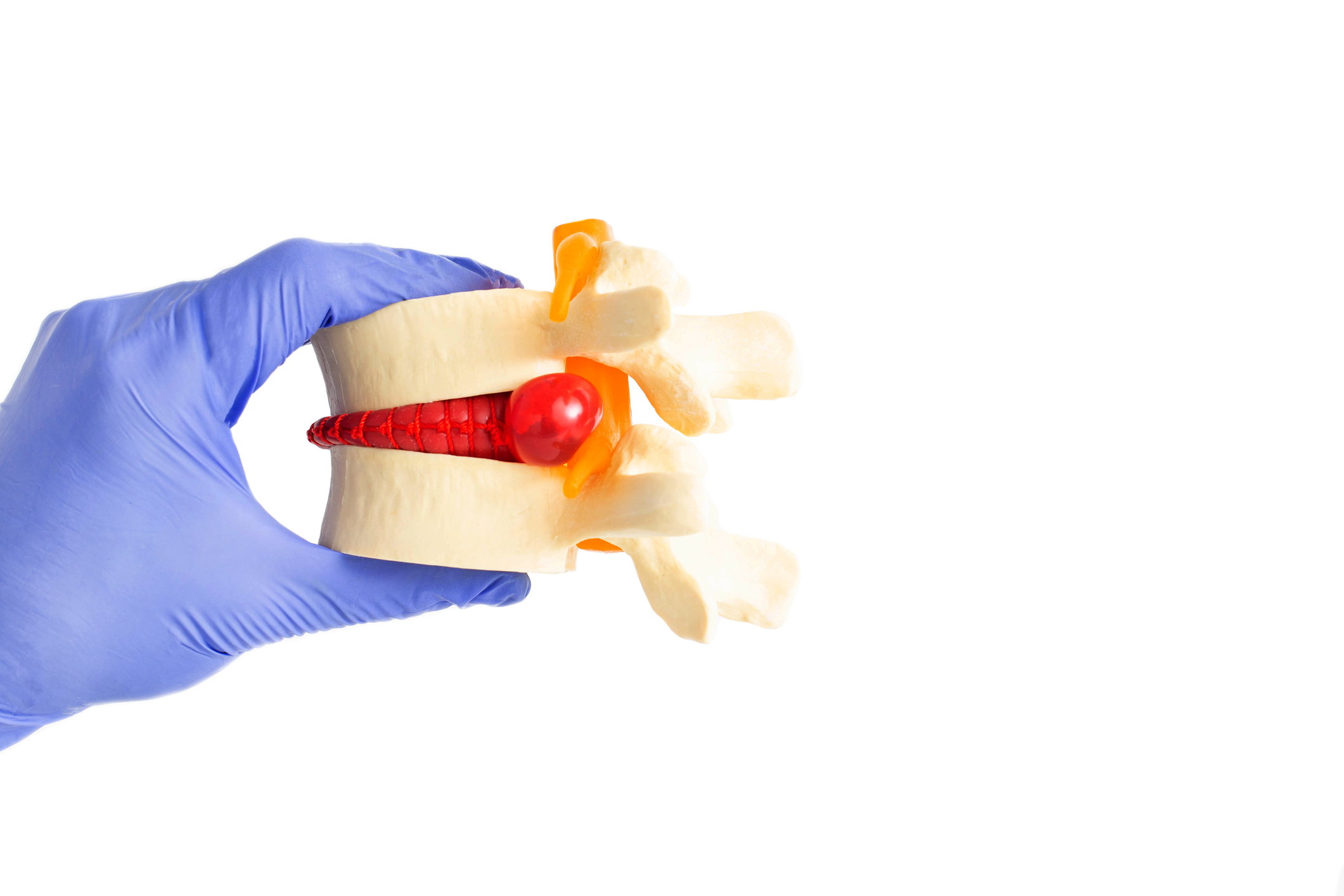 Protruzija diska: Vzroki, simptomi in zdravljenje