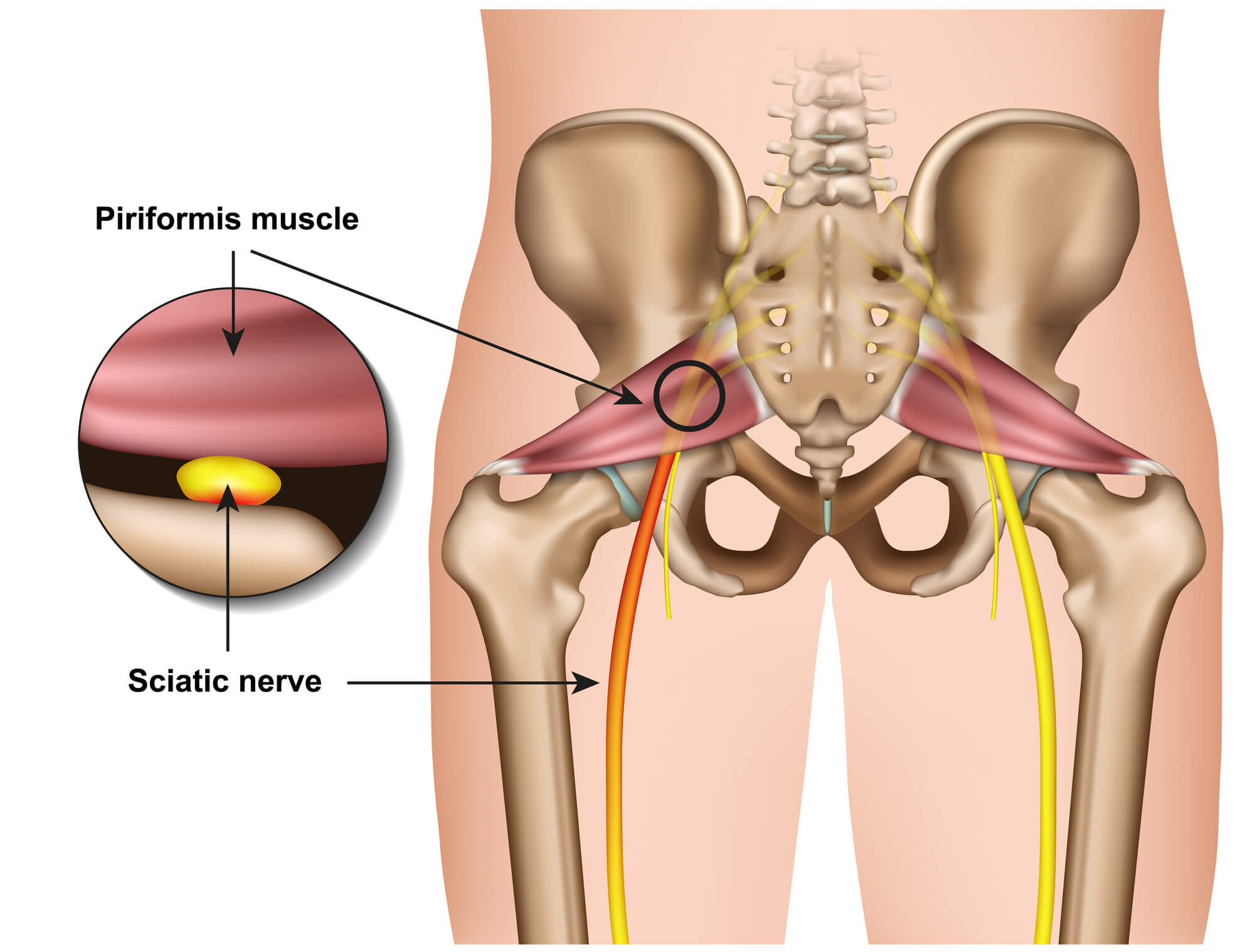 piriformis sindrom in bolečine v kolku 