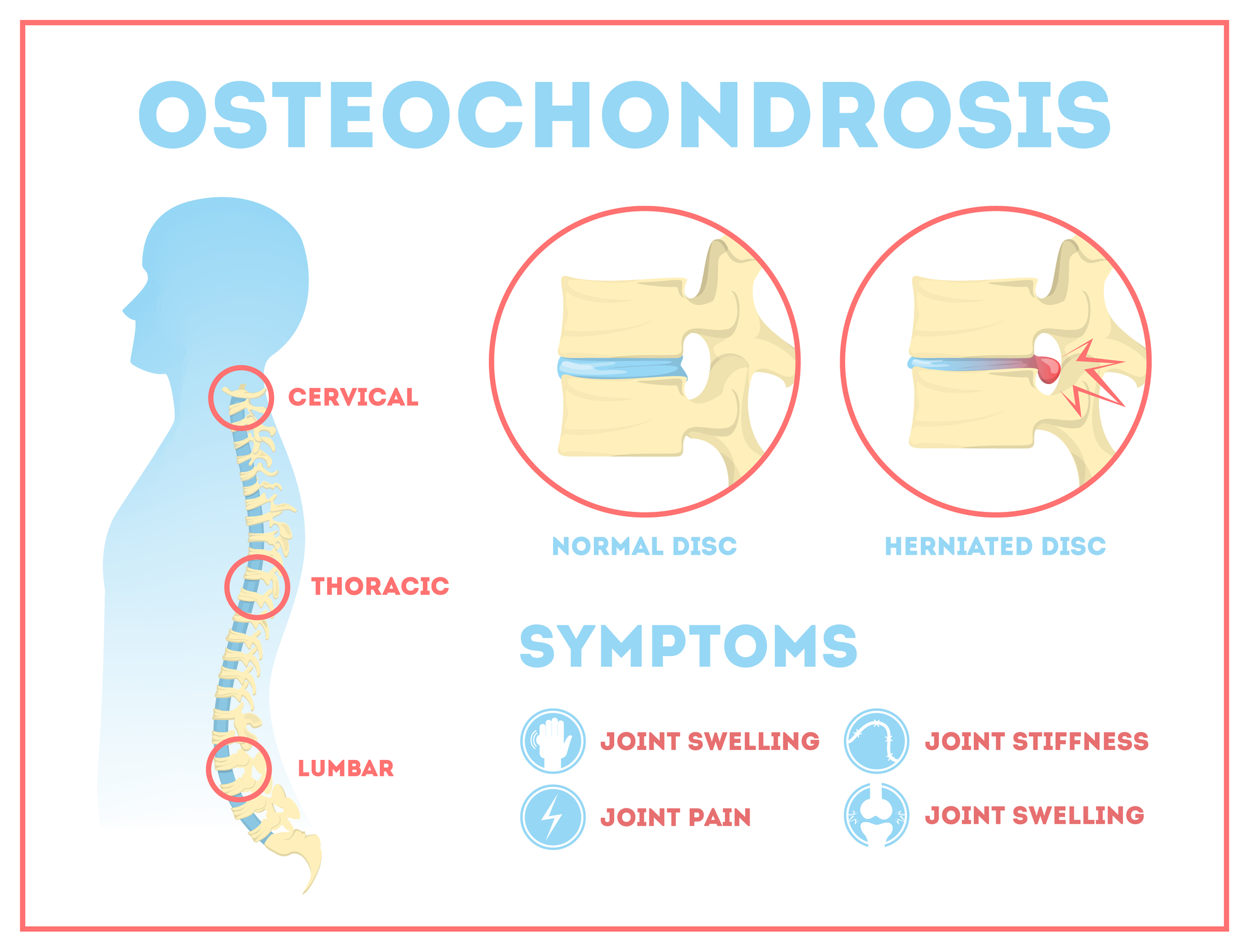 osteohondroza simptomi bolečine v križu