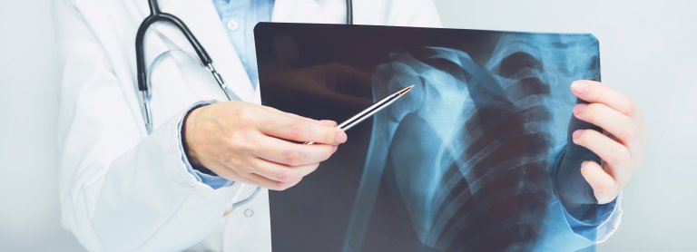 Utesnitveni sindrom rame