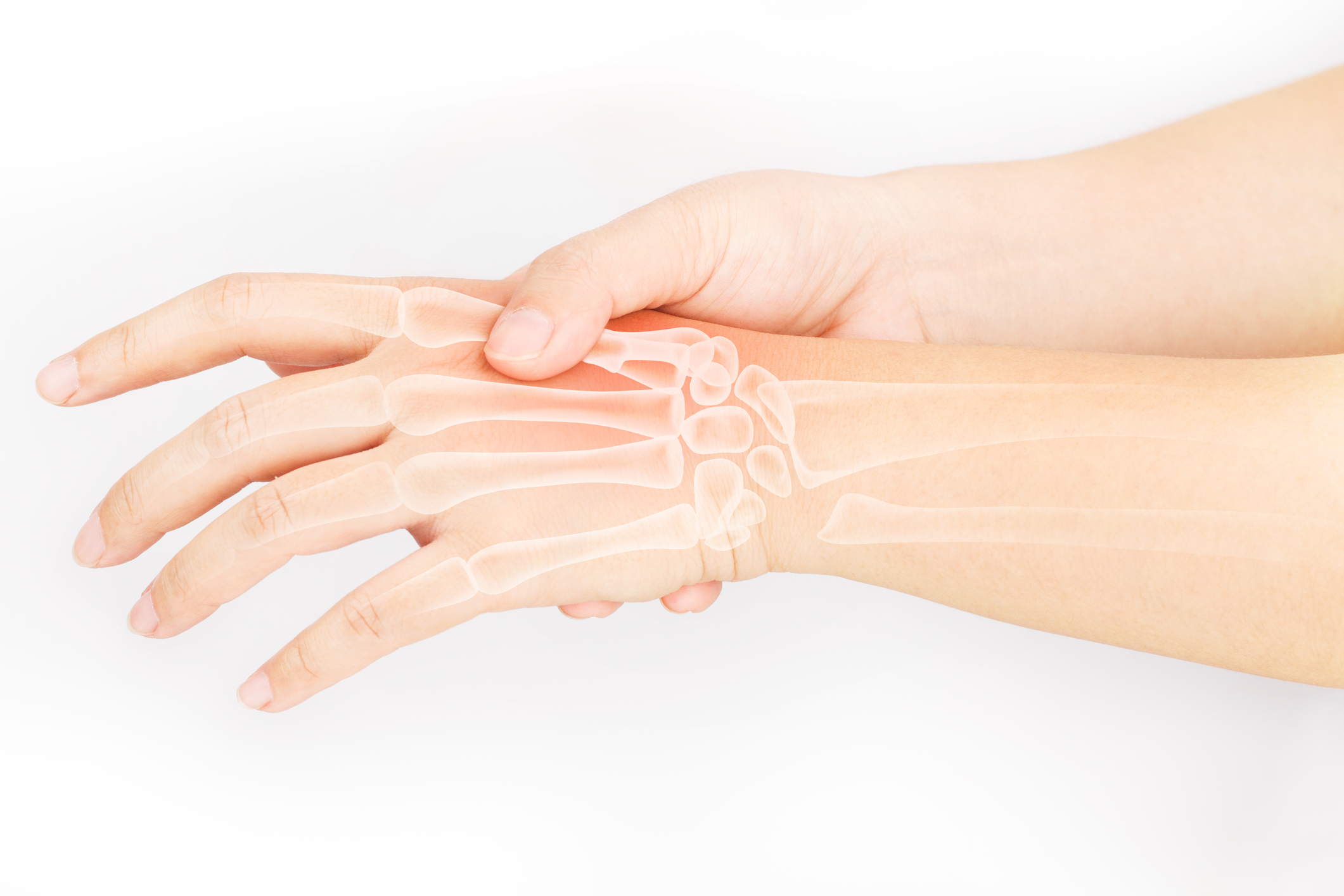 Heberdenovi vozliči in Bouchardovi vozliči