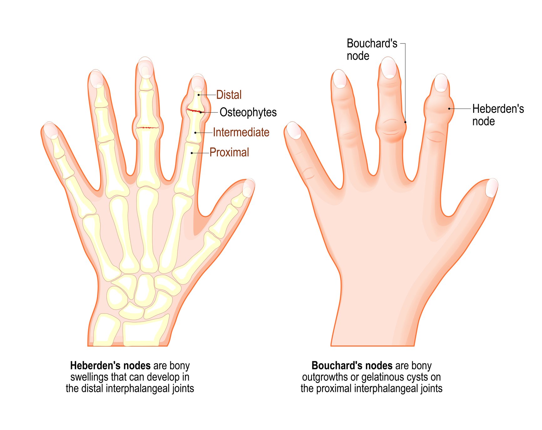 Bouchardovi vozliči in Heberdenovi vozliči znak osteoartroze