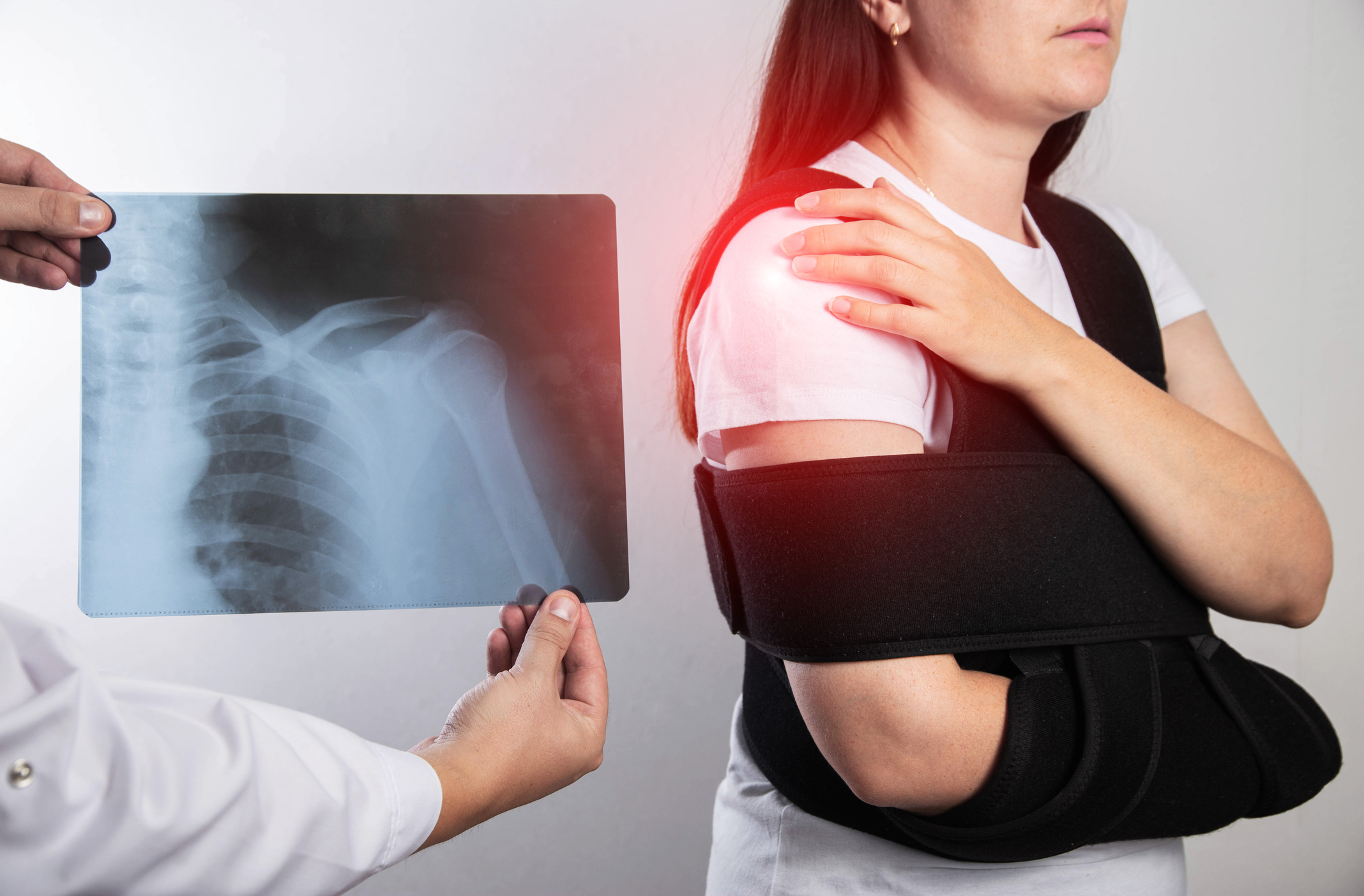 imobilizacija po zlomu nadlahtnice