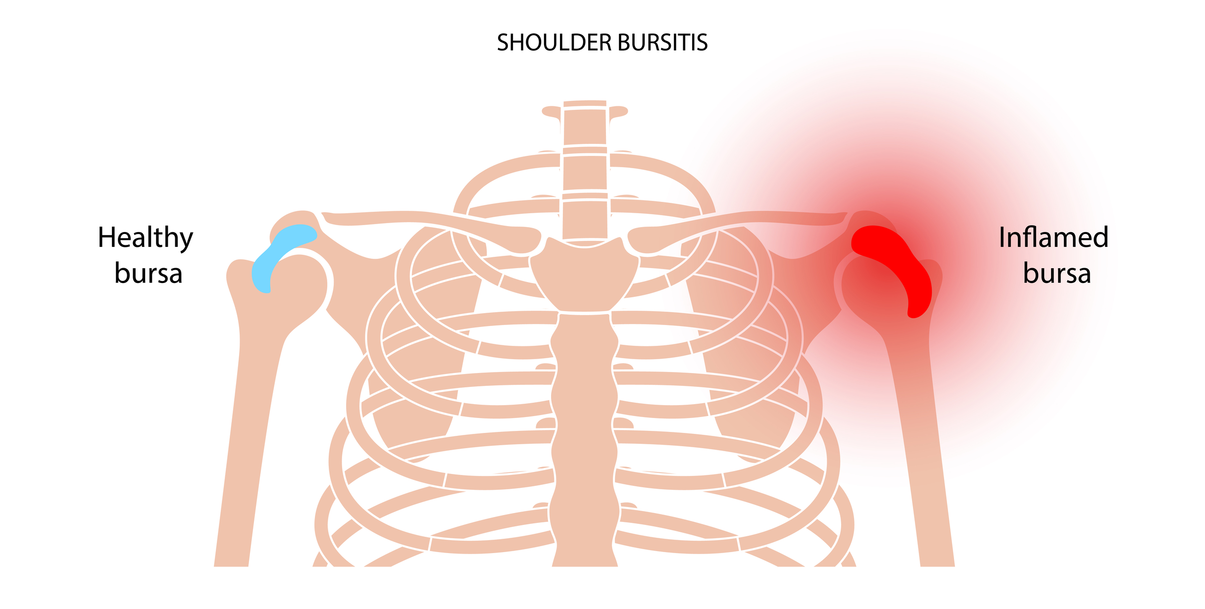 vnetje burze v rami simtptomi
