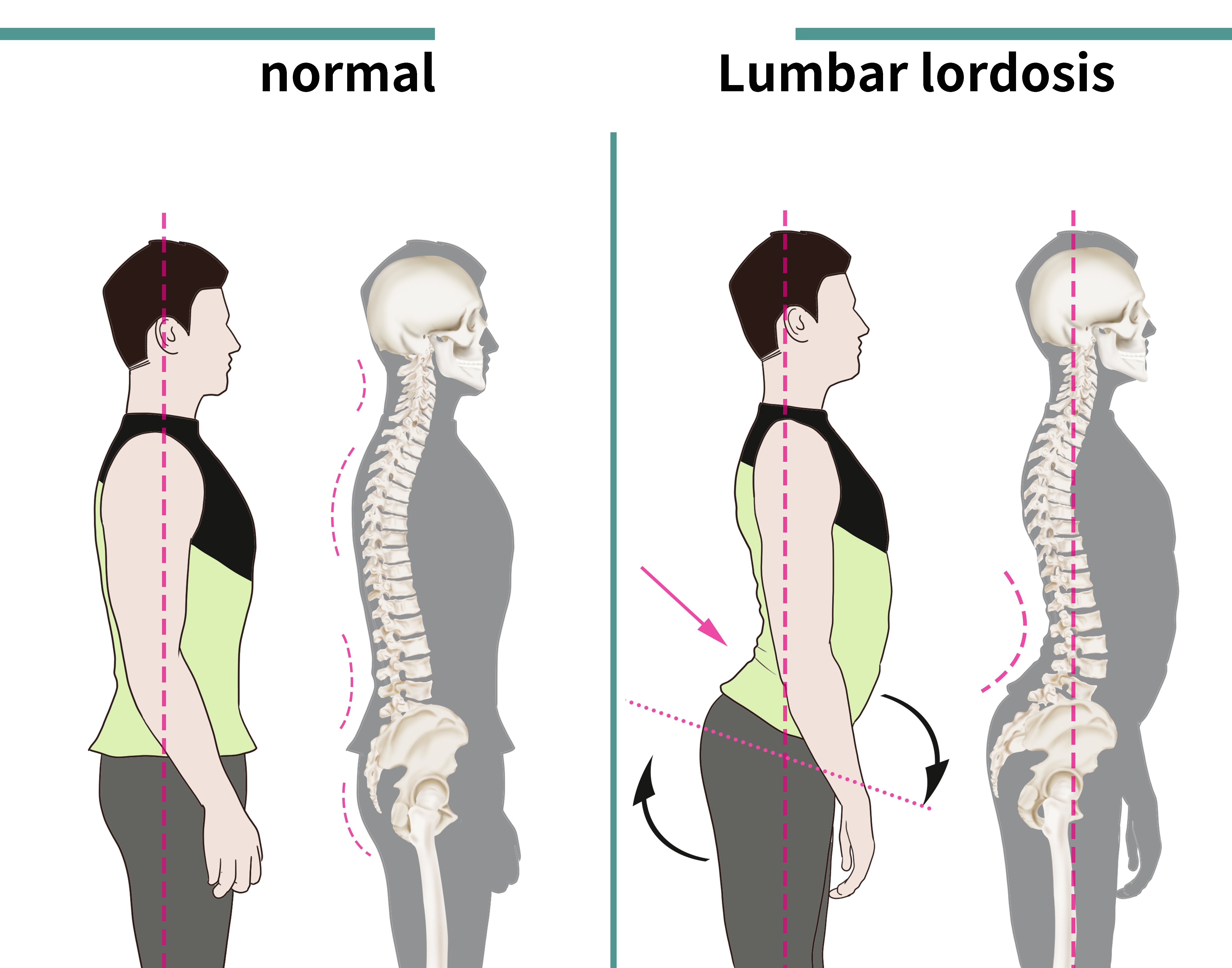 ledvena lordoza bolečine drža