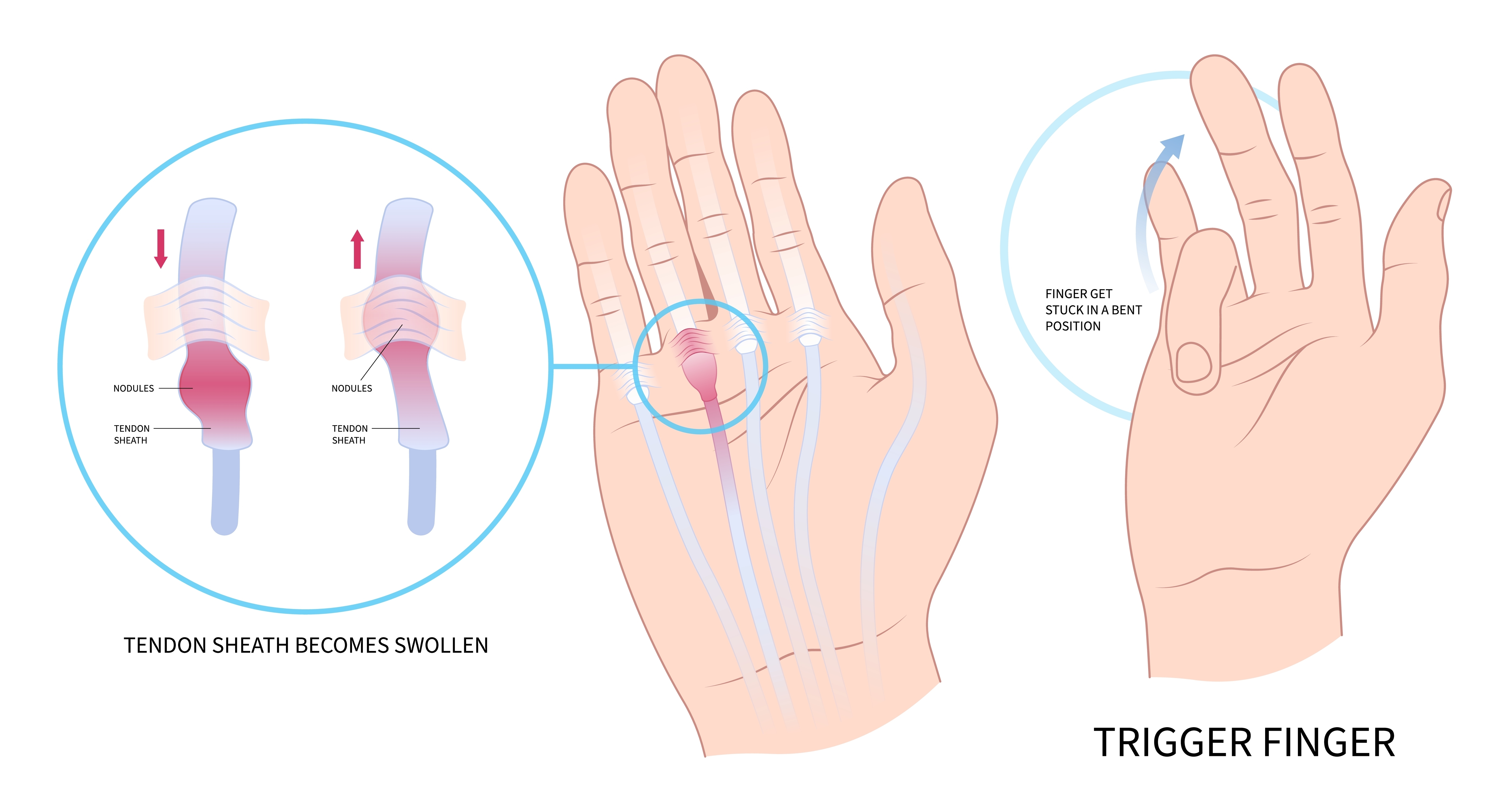 trigger finger prsti