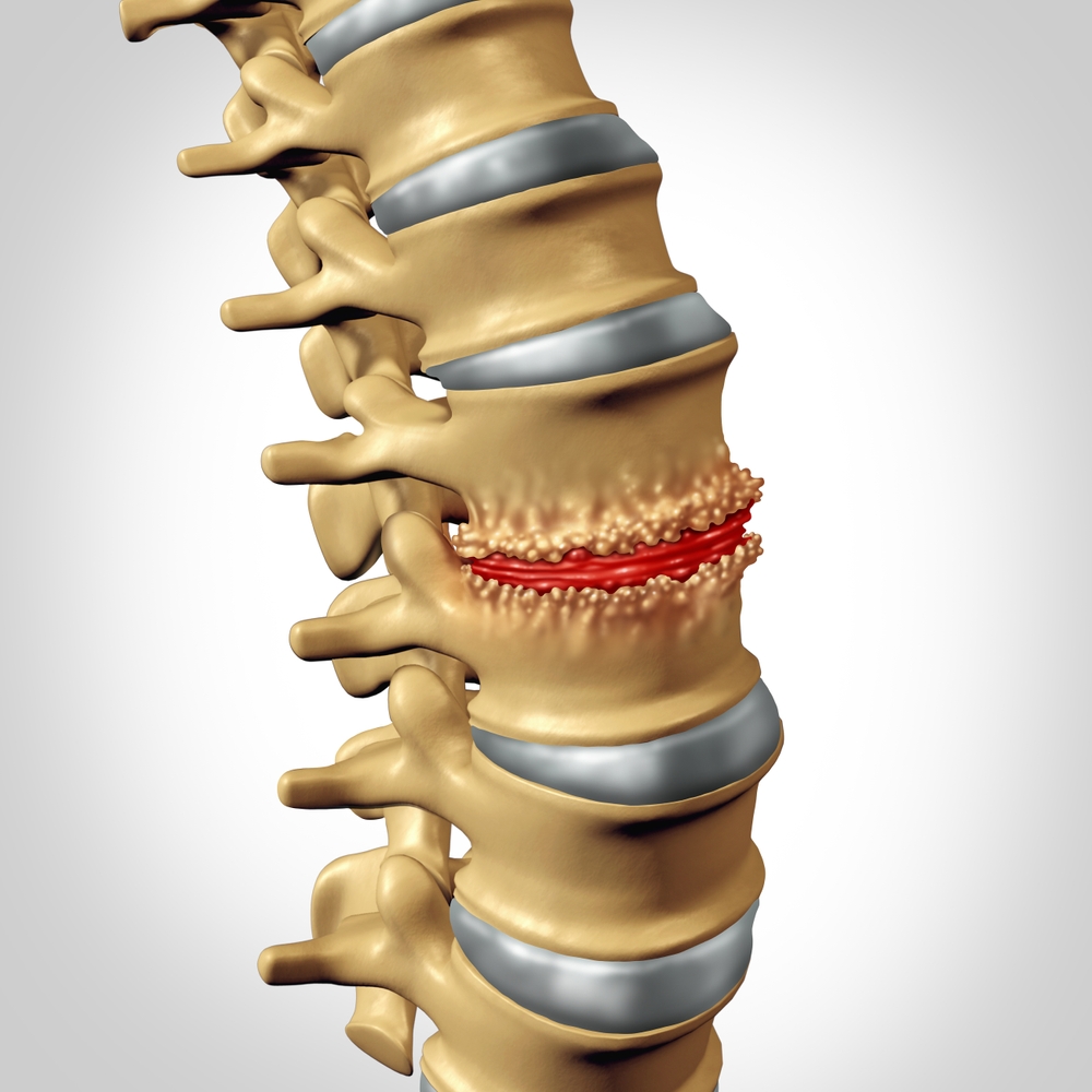 Osteofiti na hrbtenici