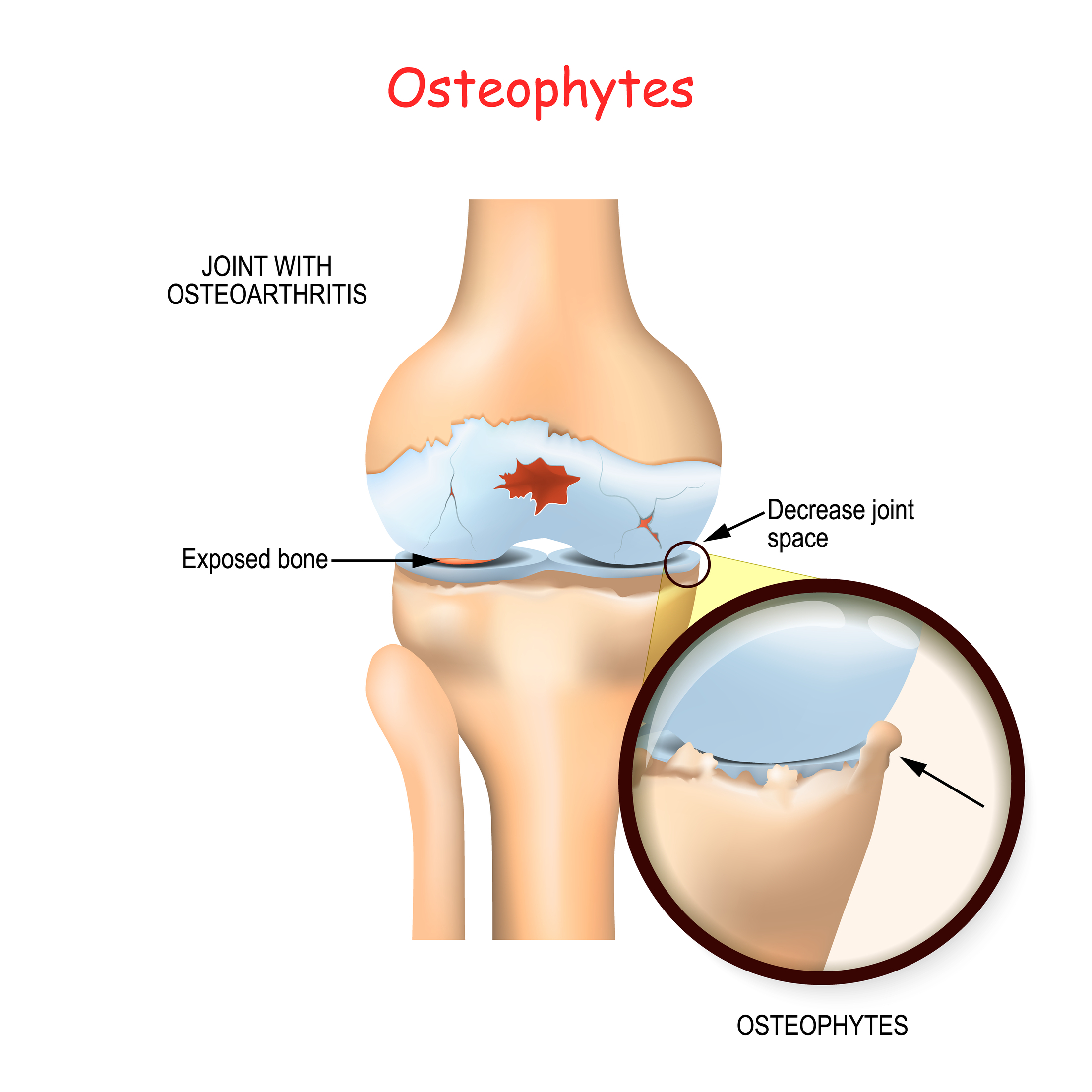 Osteofiti ali kostni izrastki na kolenu
