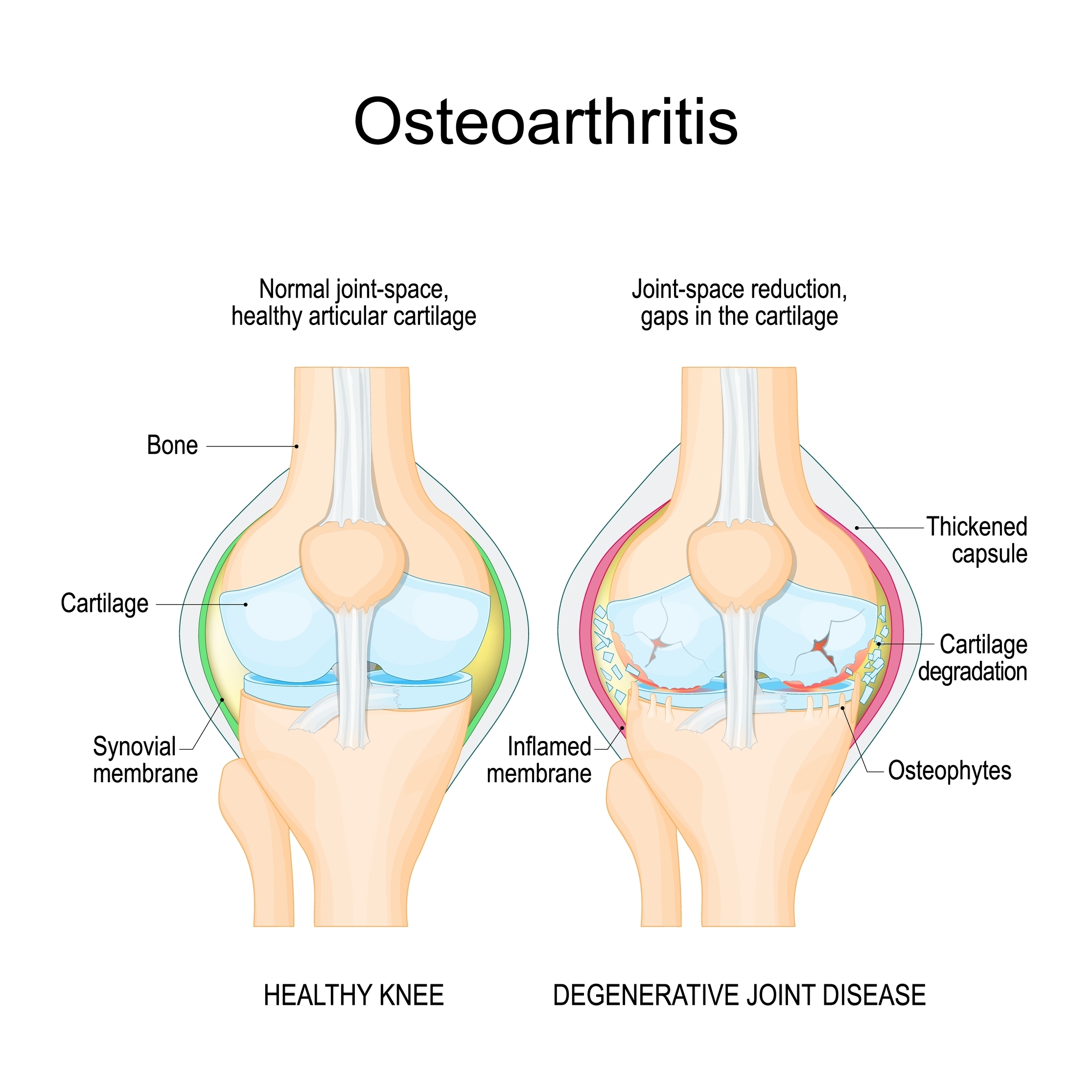 Osteoartritis vpliva na pojav osteofitov