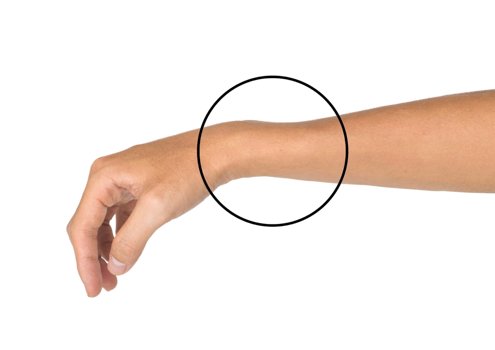 Simtpomi zloma zapestja