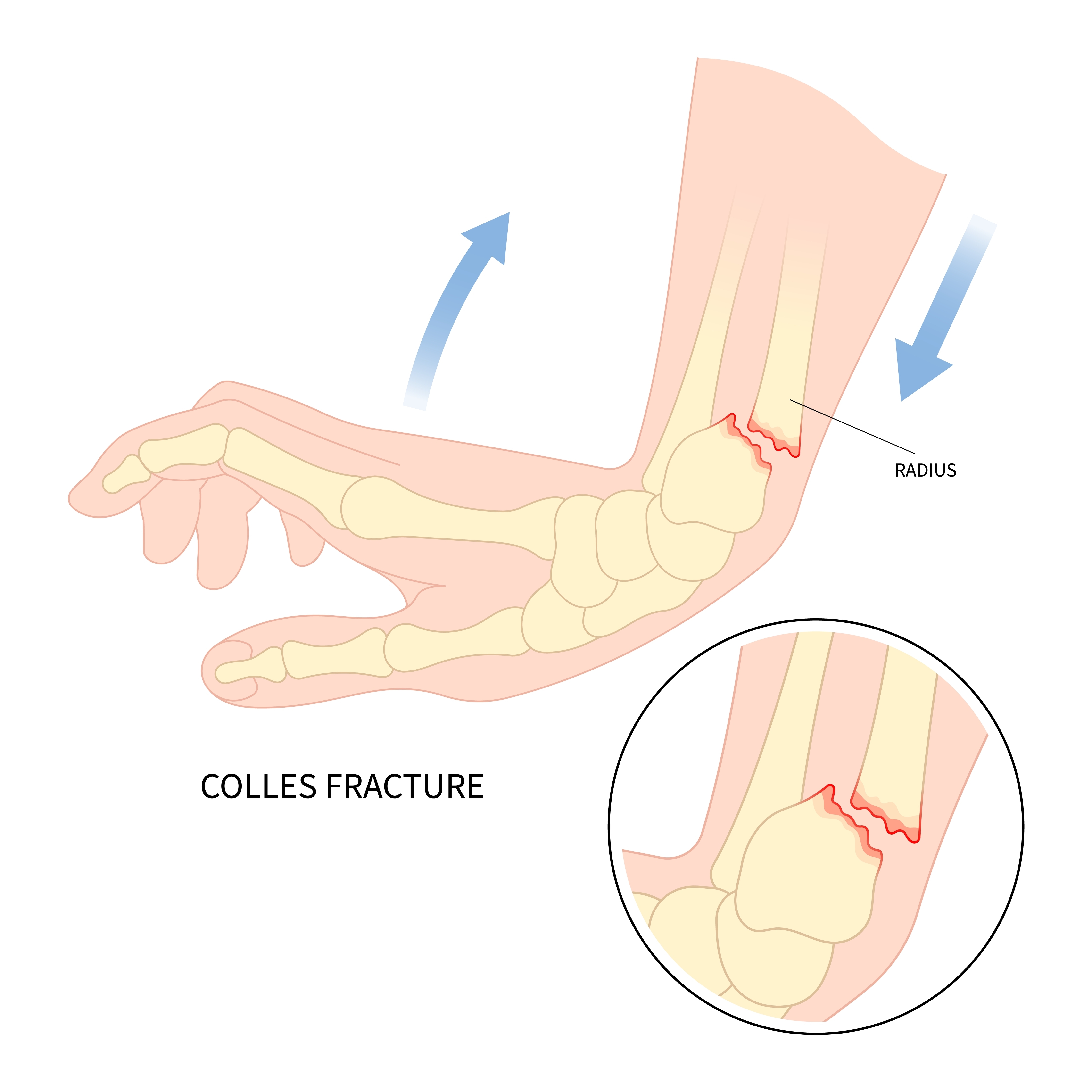Kako pride do zloma zapestja