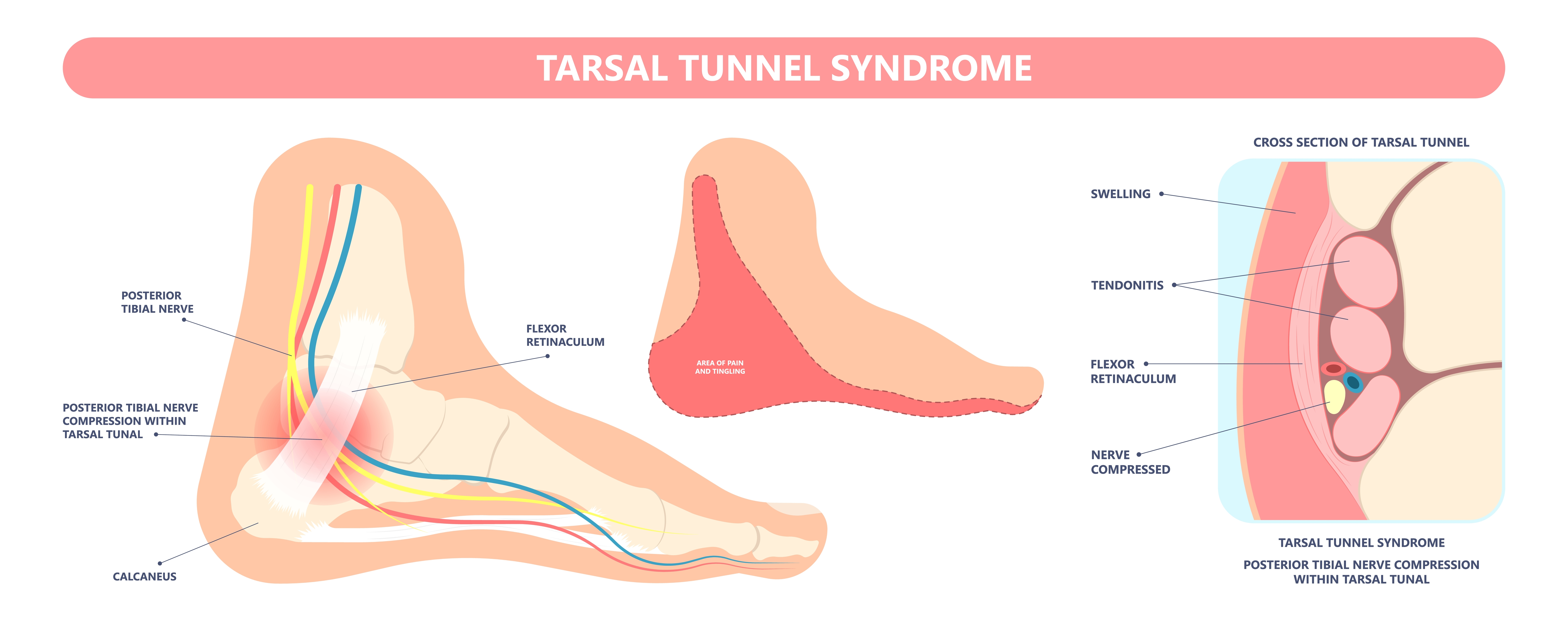 Vkleščenje živca v tarzalnem kanalu
