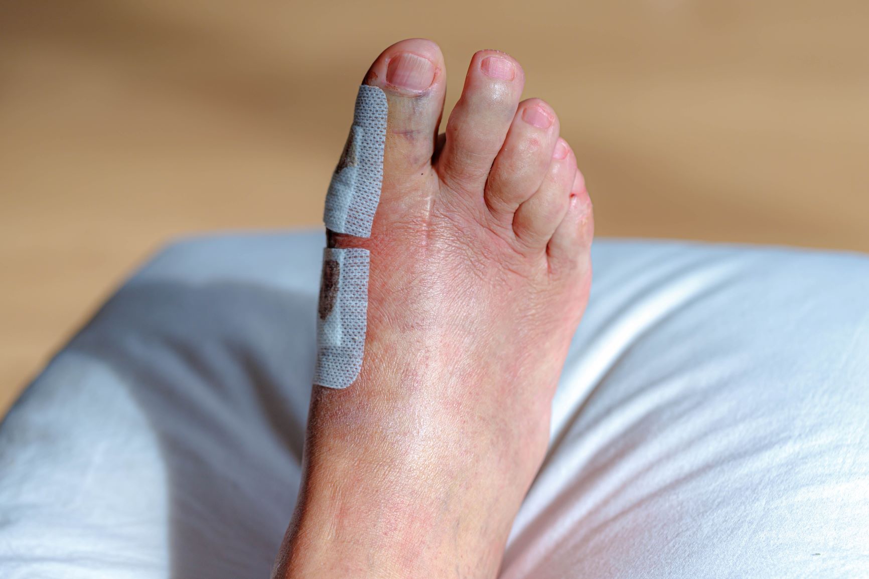 Fizioterapija po operaciji hallux valgus
