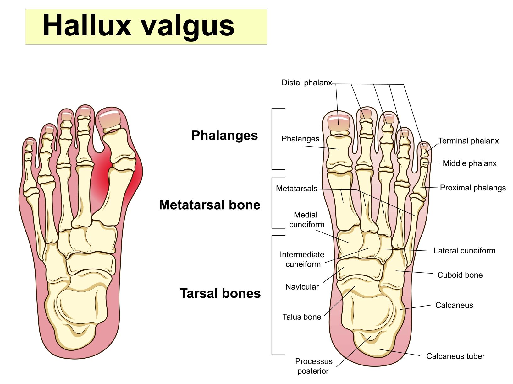 Hallux Valgus Anatomija