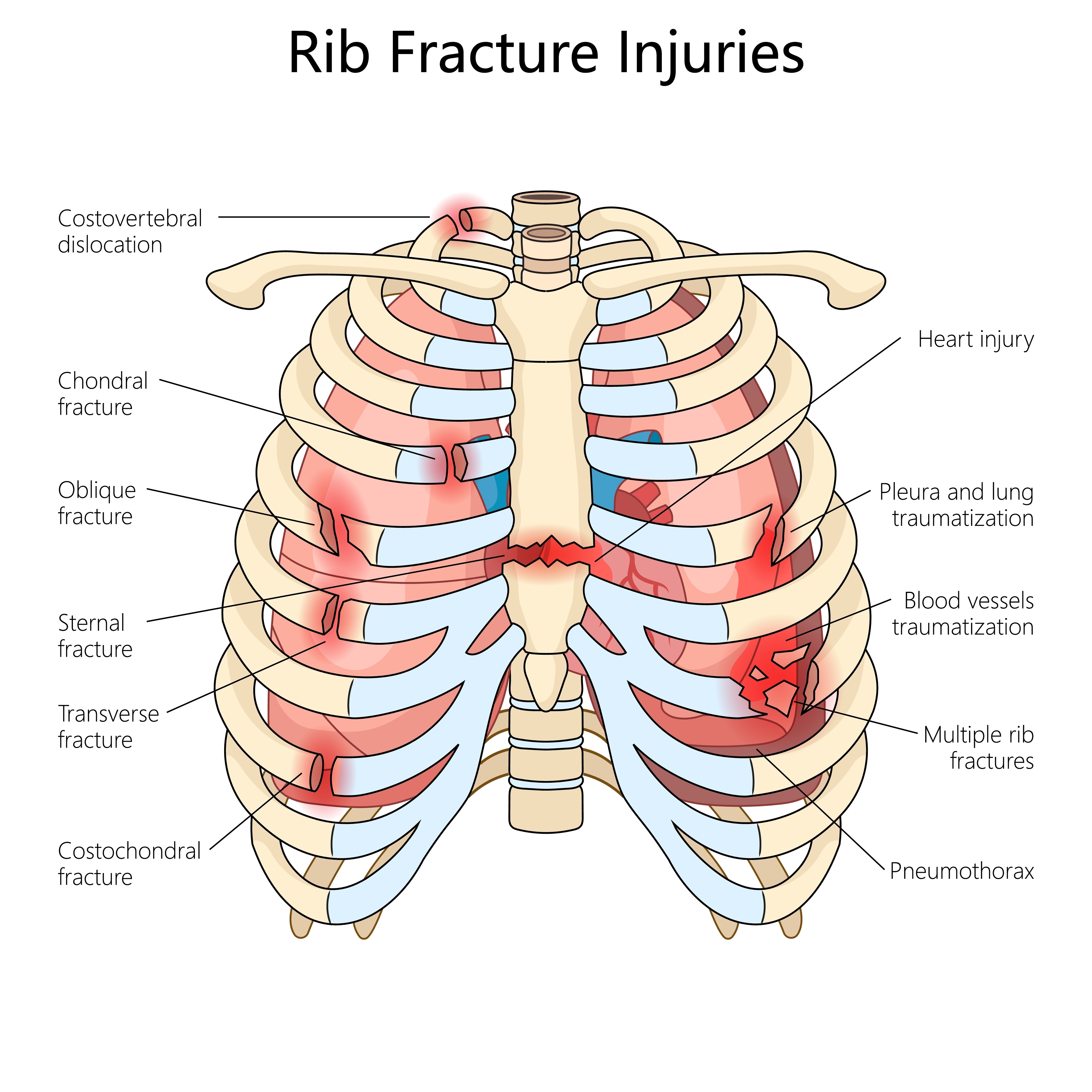 Simptomi poškodbe reber