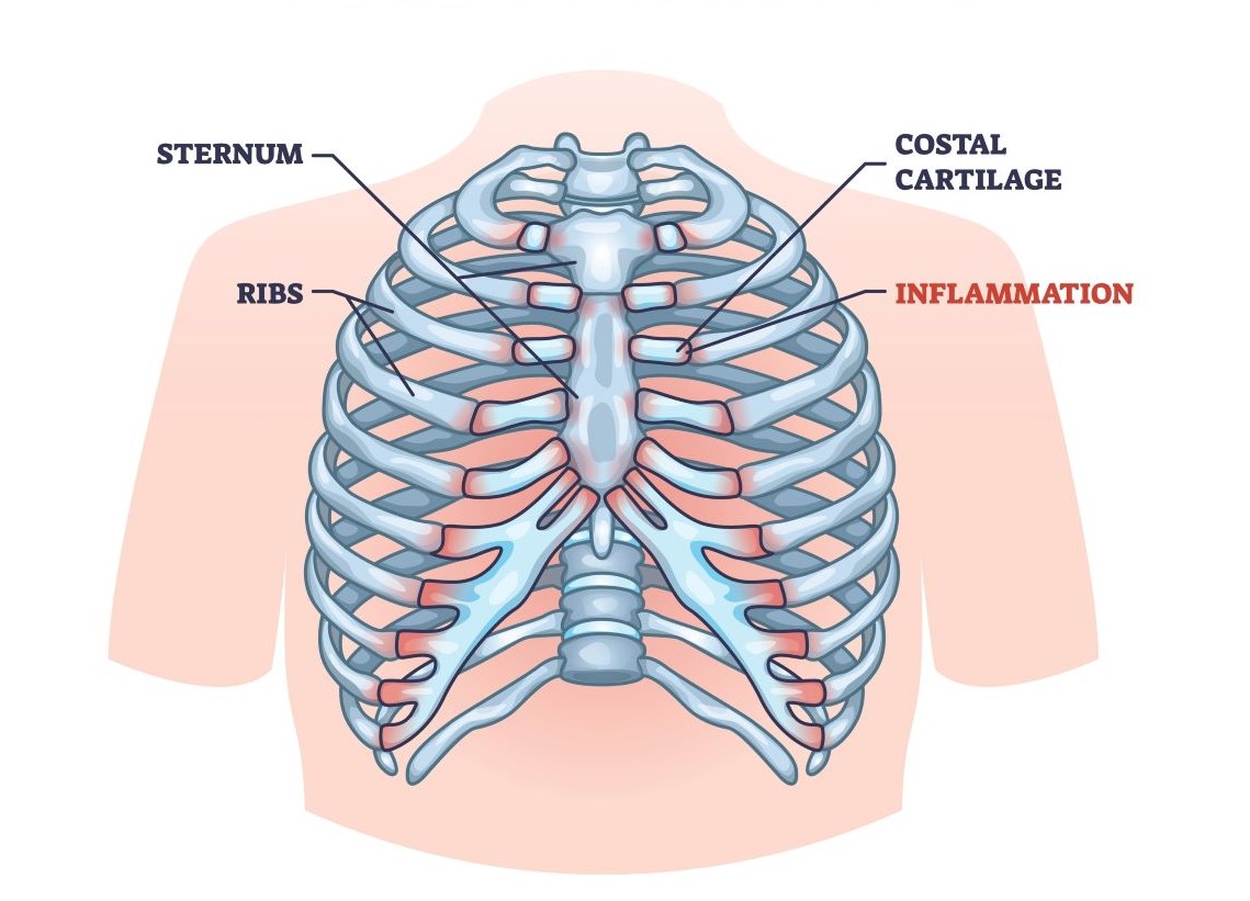 Kostohondritis