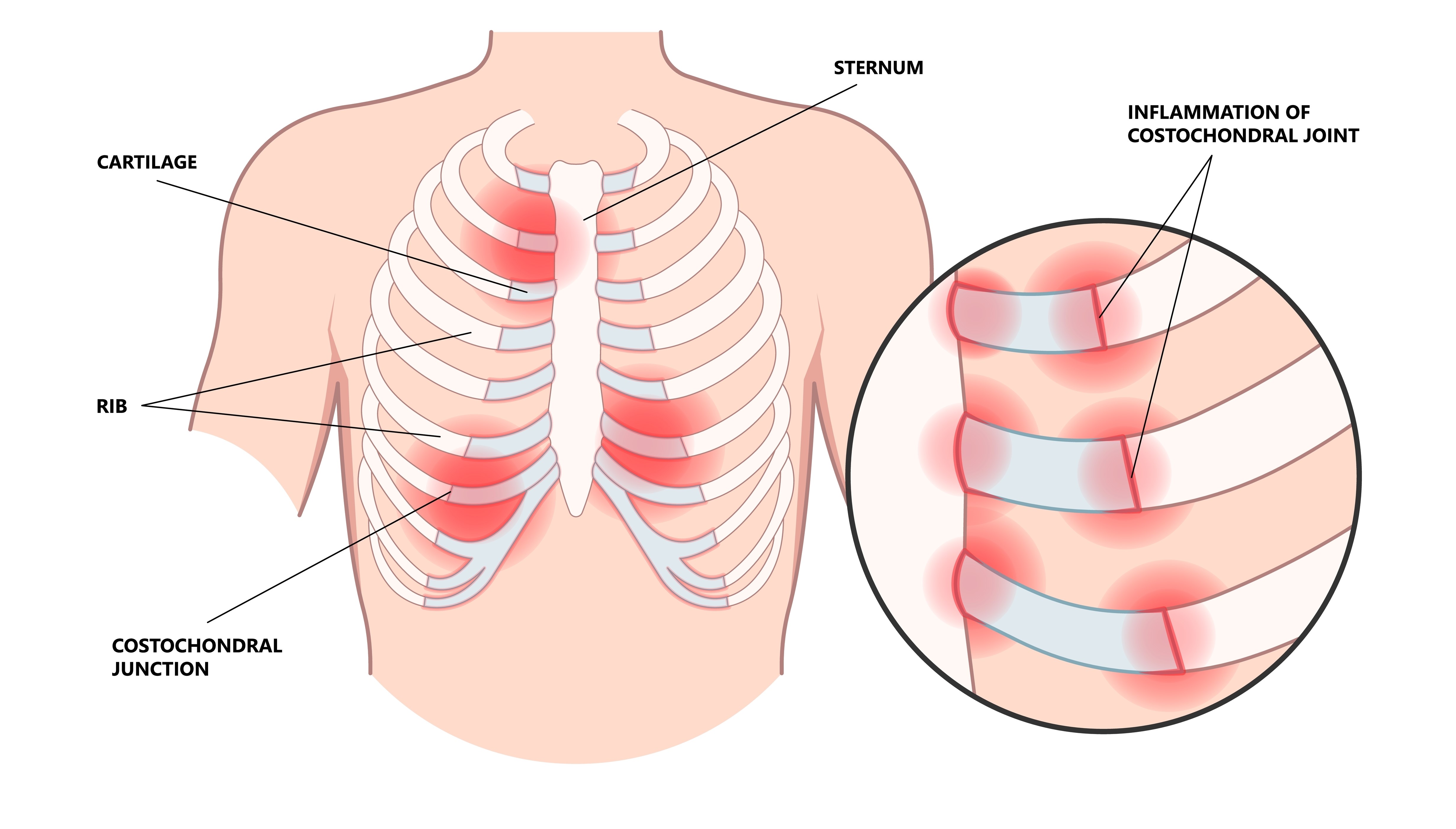 Kaj je kostohondritis