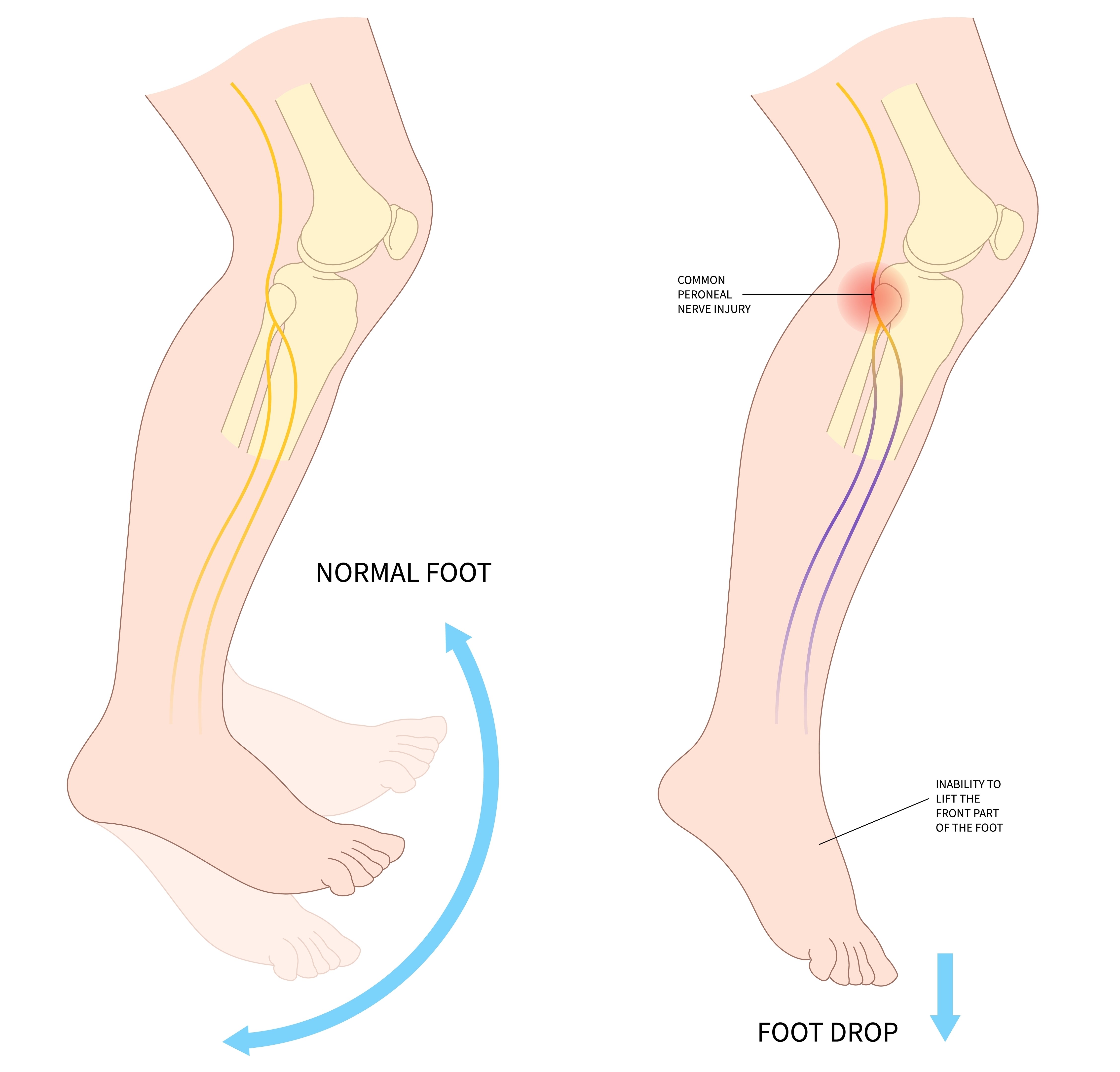 Kaj je padajoče stopalo