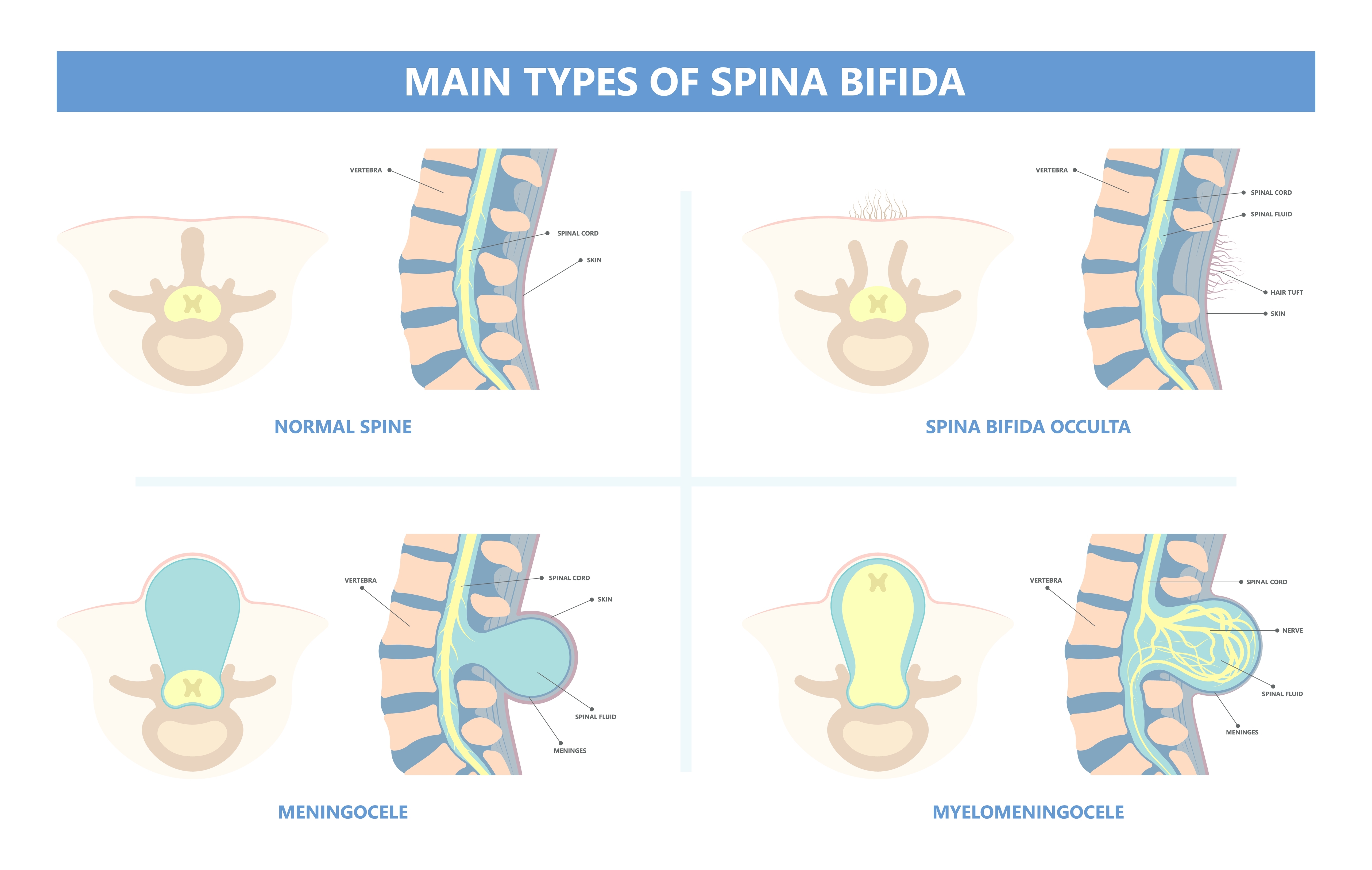 Spina bifida