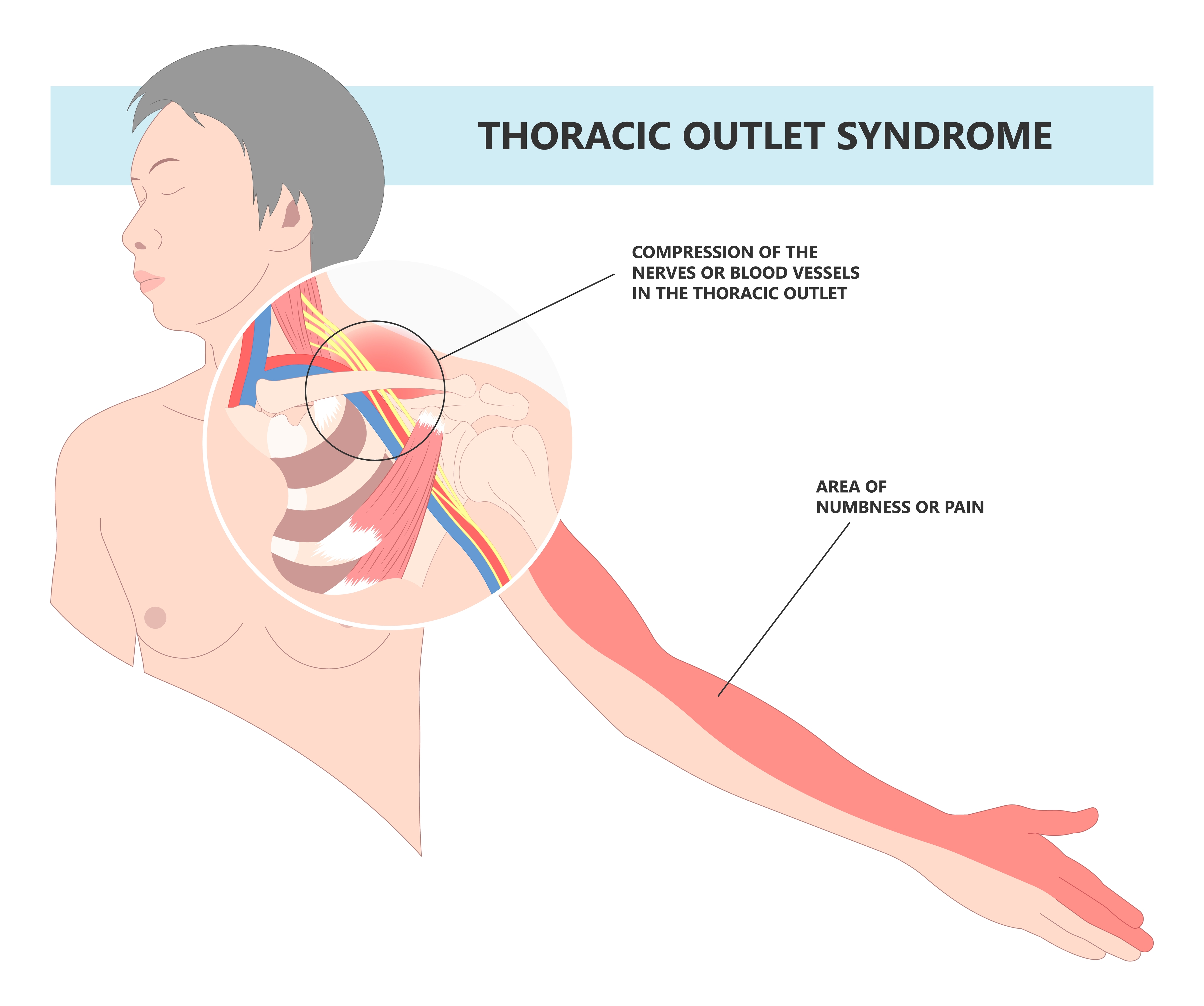 Sindrom torakalnega izhoda