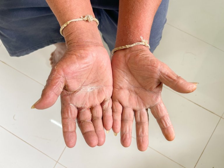 Skleroderma: avtoimunska bolezen vezivnega tkiva